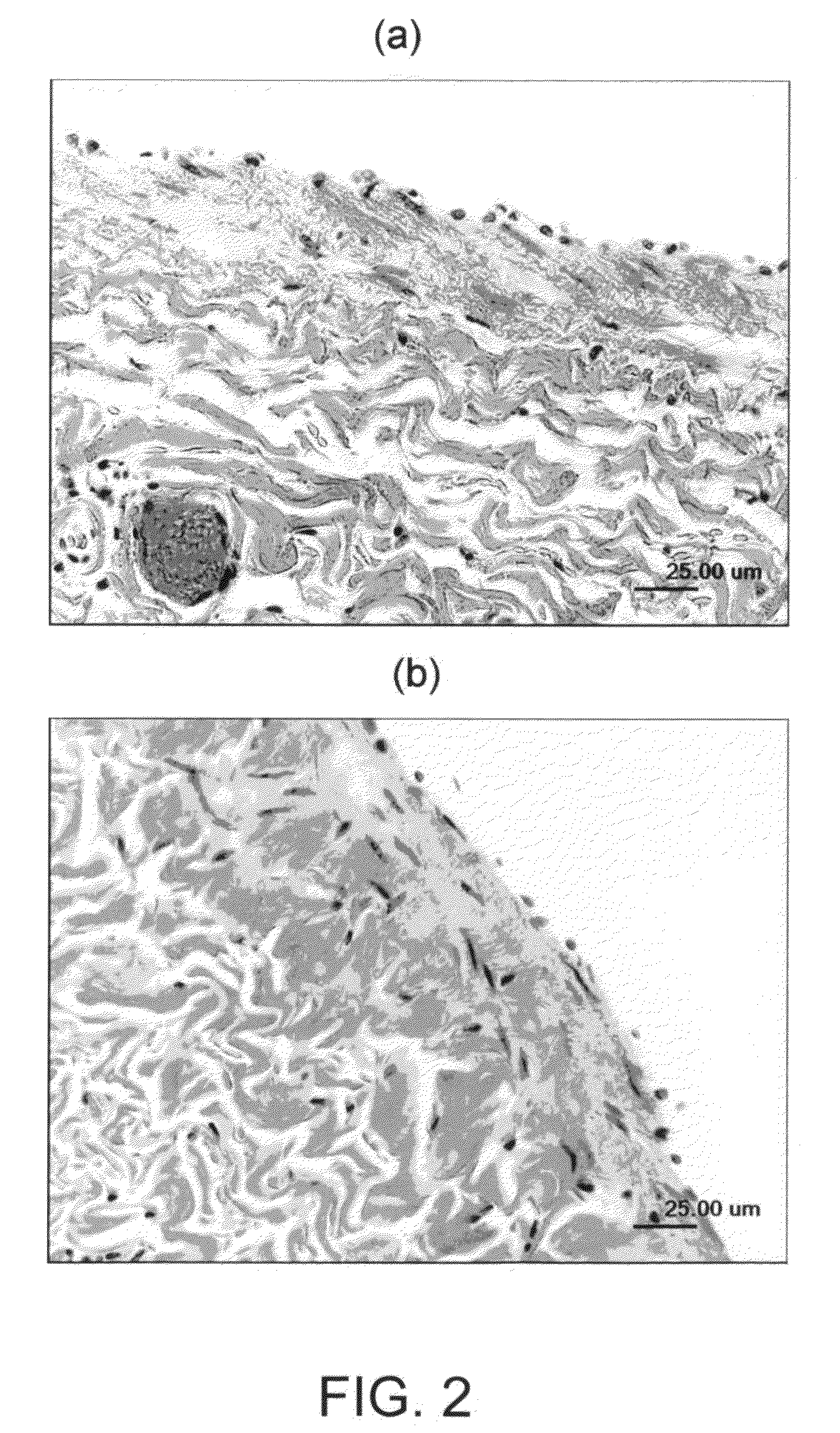 Articles and methods of treating vascular conditions