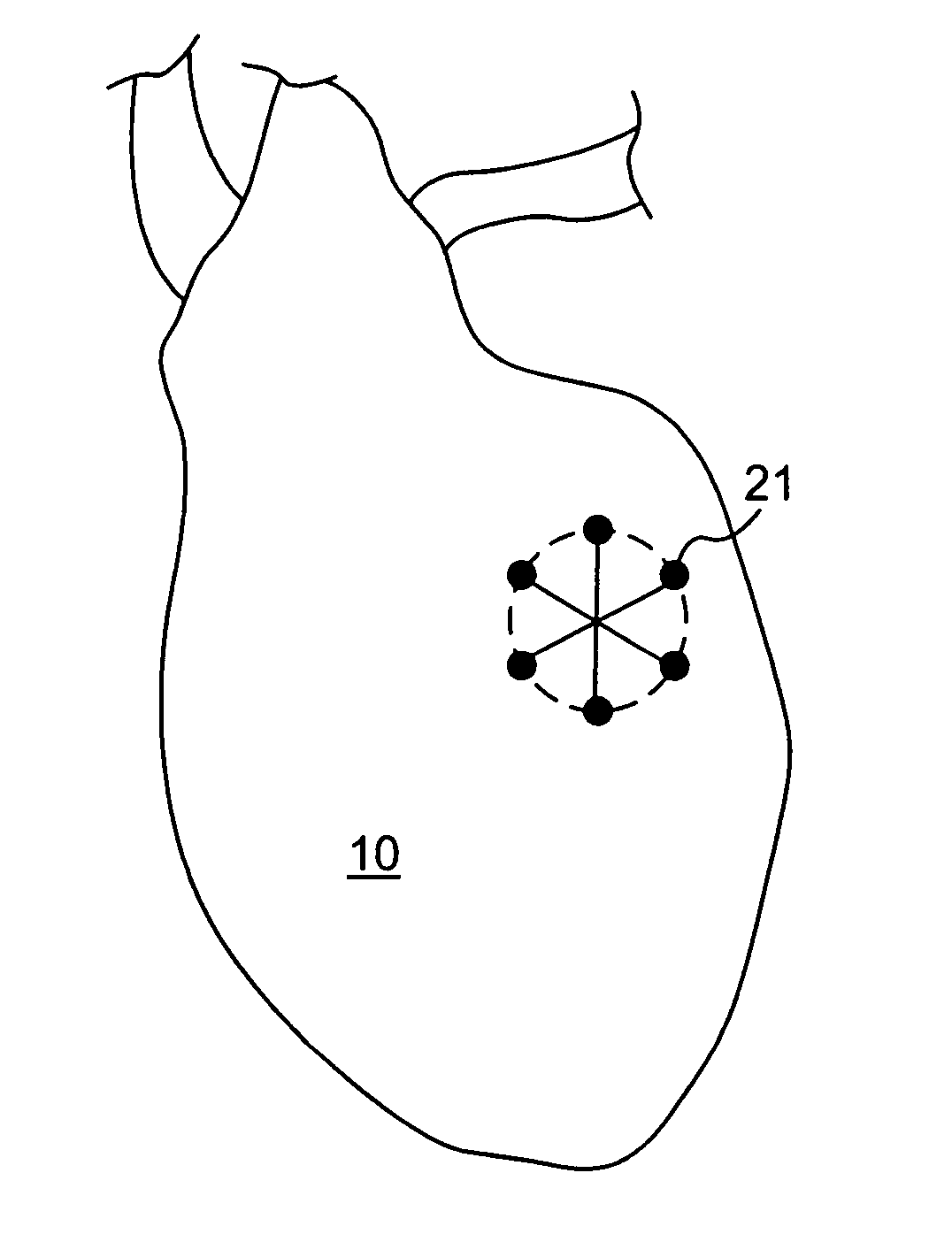 Prevention of myocardial infarction induced ventricular expansion and remodeling