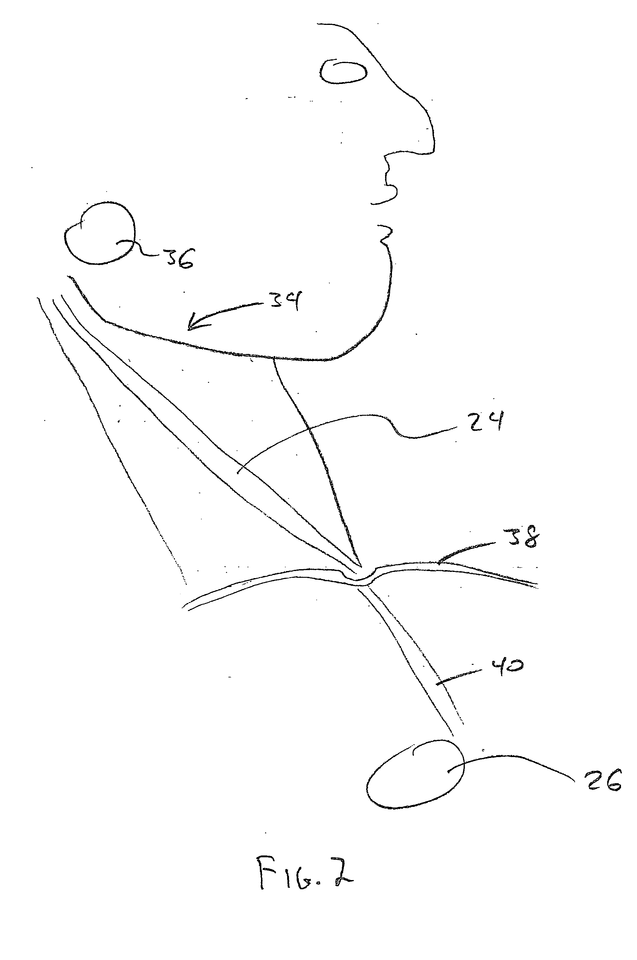 Device and procedure to treat cardiac atrial arrhythmias