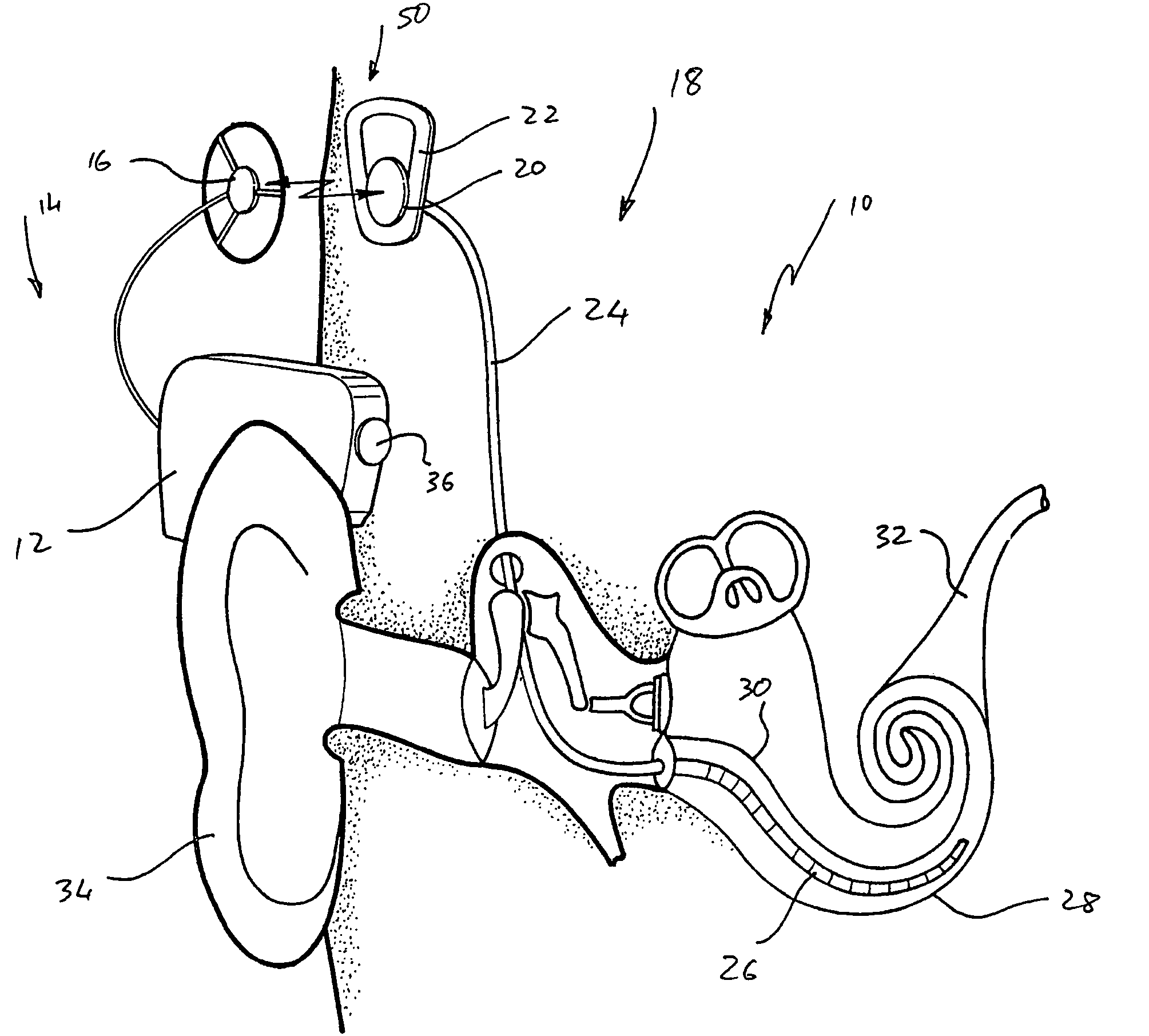 External speech processor unit for an auditory prosthesis