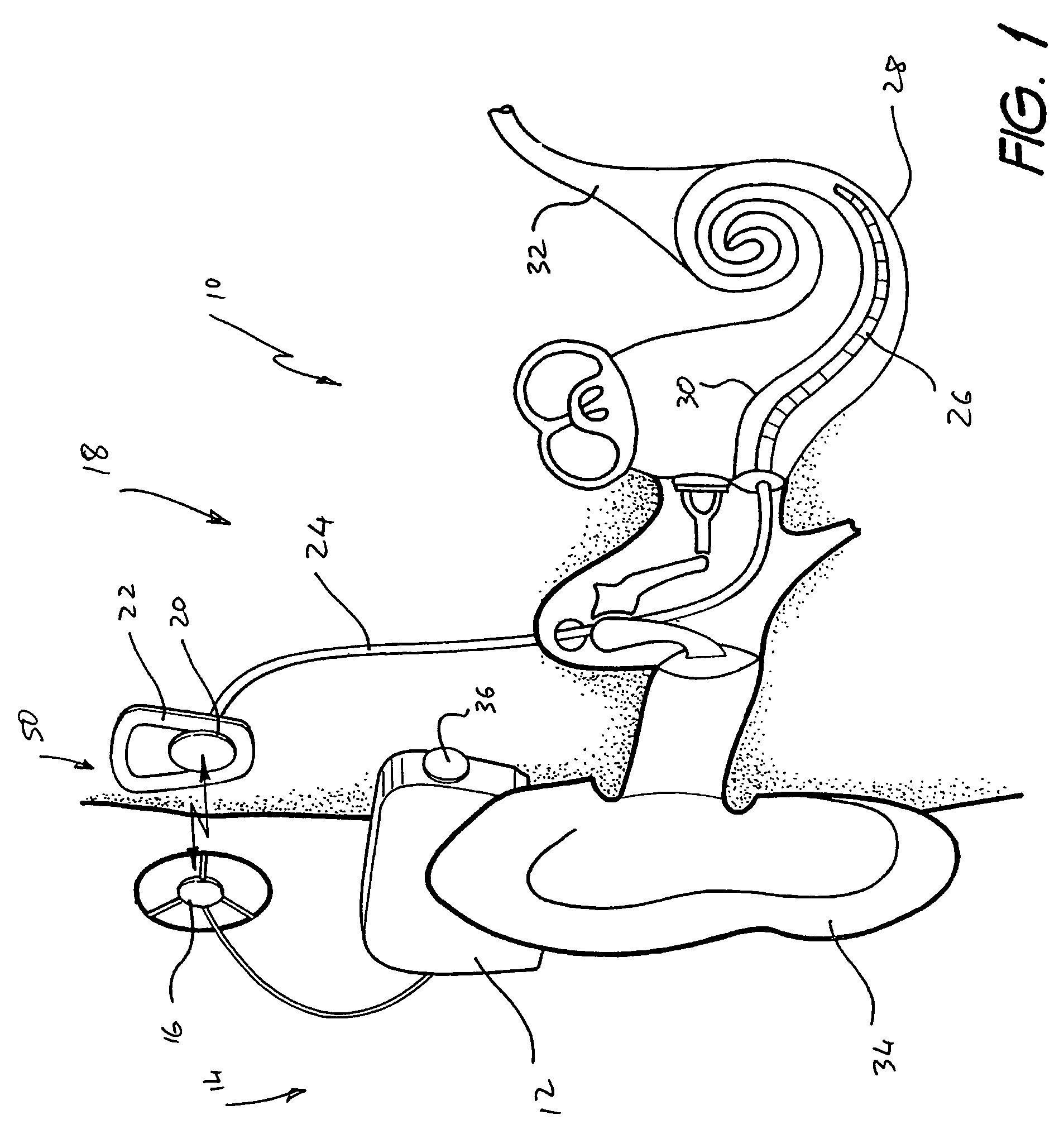 External speech processor unit for an auditory prosthesis