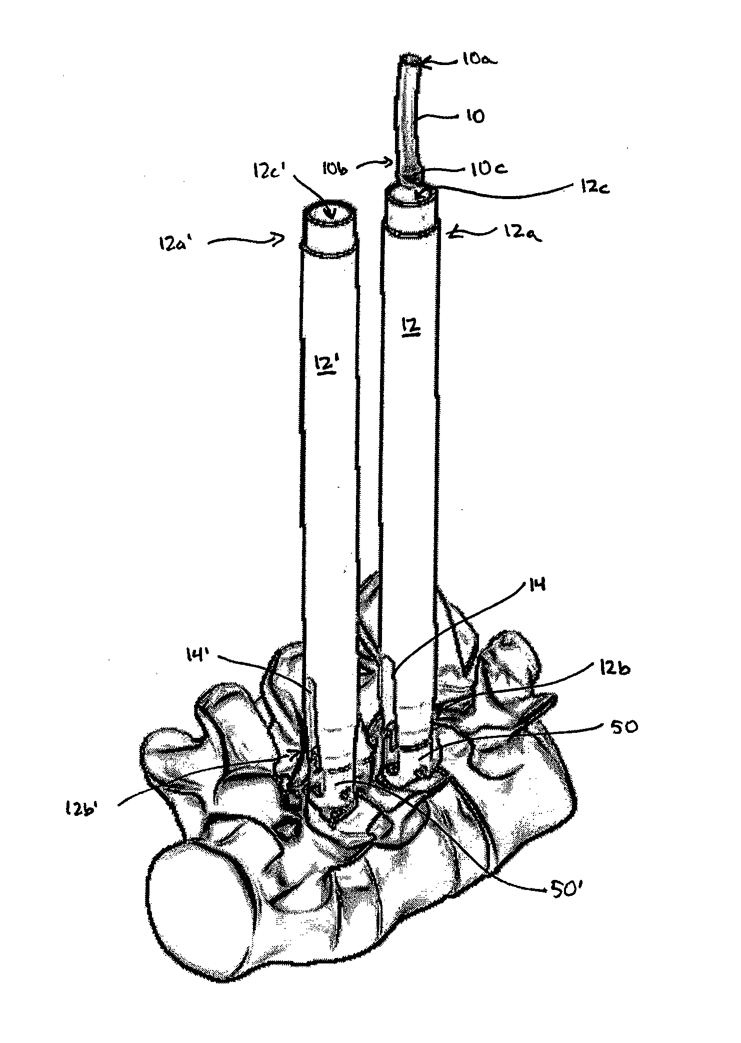 Spinal fixation element and methods