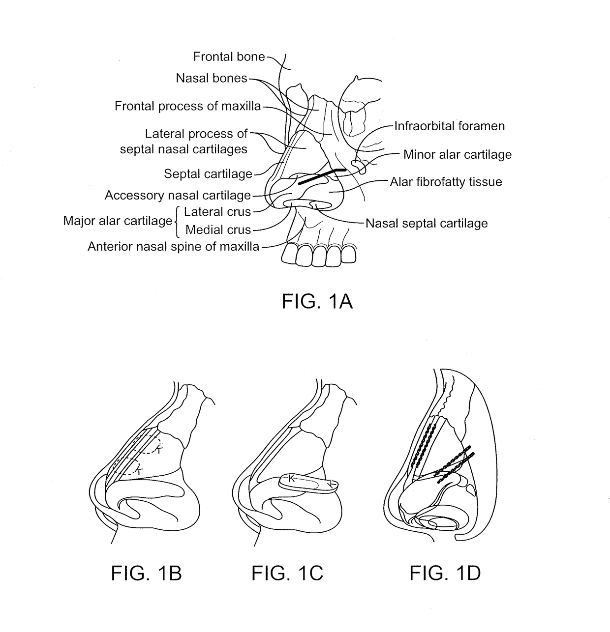 Nasal implants and systems and methods of use