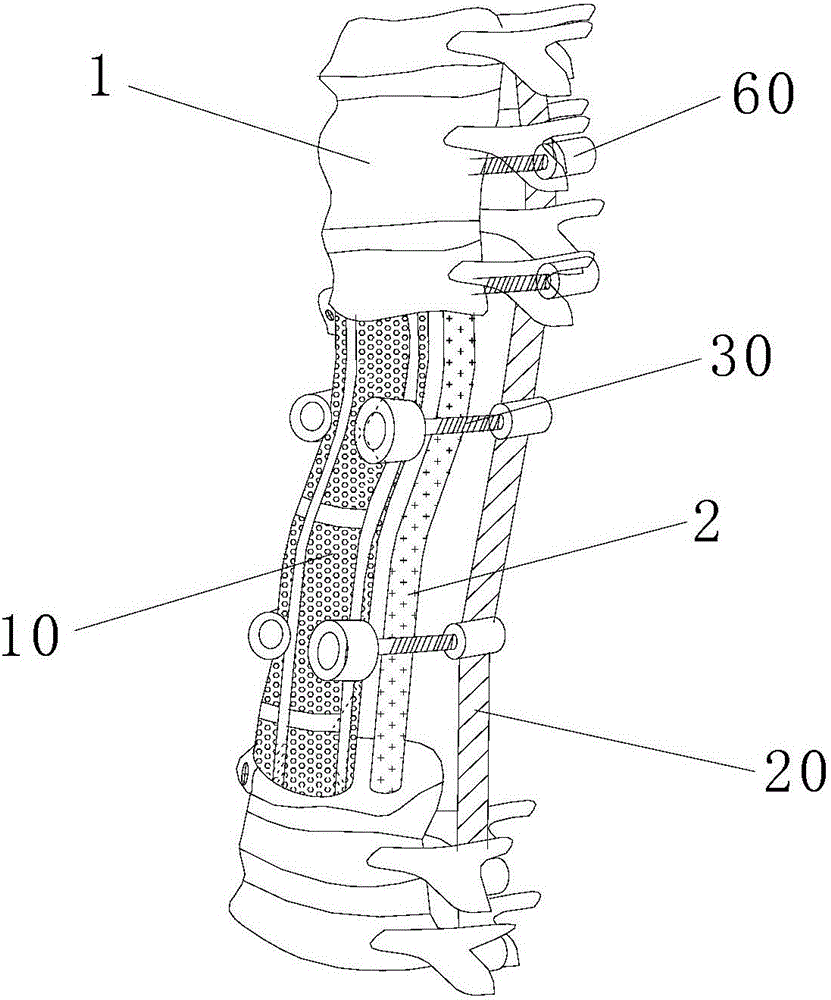 Artificial vertebral body fixing system