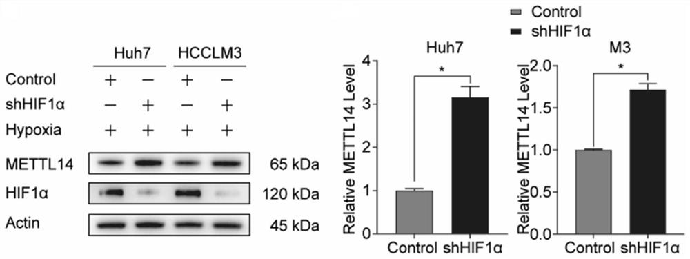 Application of SLC7A11 gene in hepatocellular carcinoma interventional embolization post operation