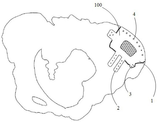 Personalized customized pelvic prosthesis and manufacturing method thereof