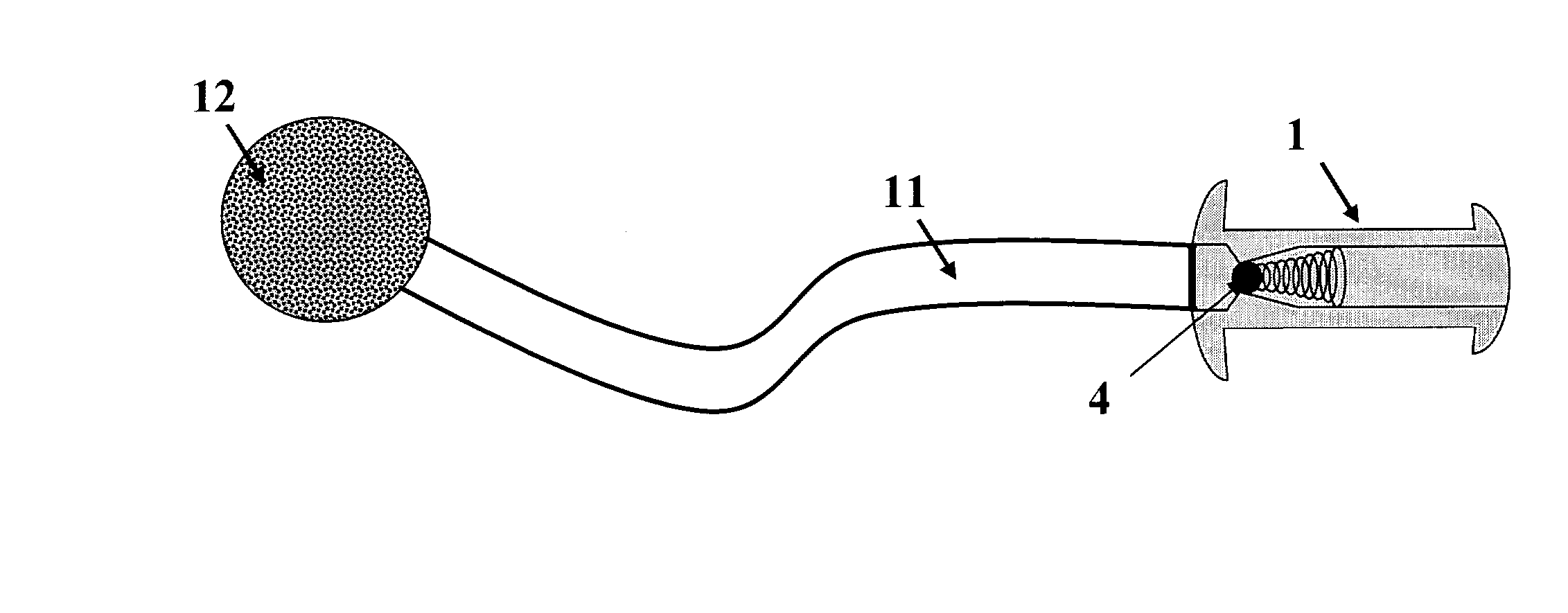 Vesicular shunt for the drainage of excess fluid