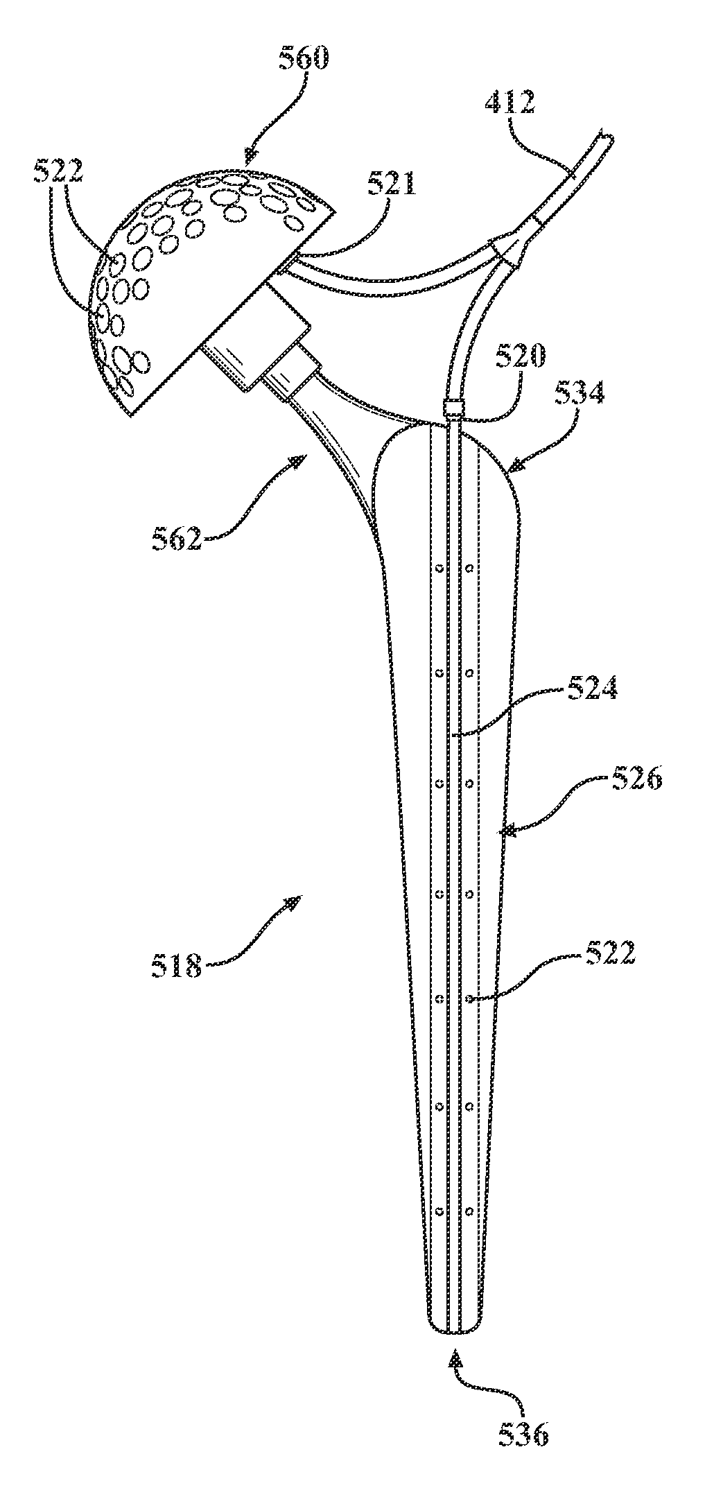 Antibiotic delivery system and method for treating an infected synovial joint during re-implantation of an orthopedic prosthesis