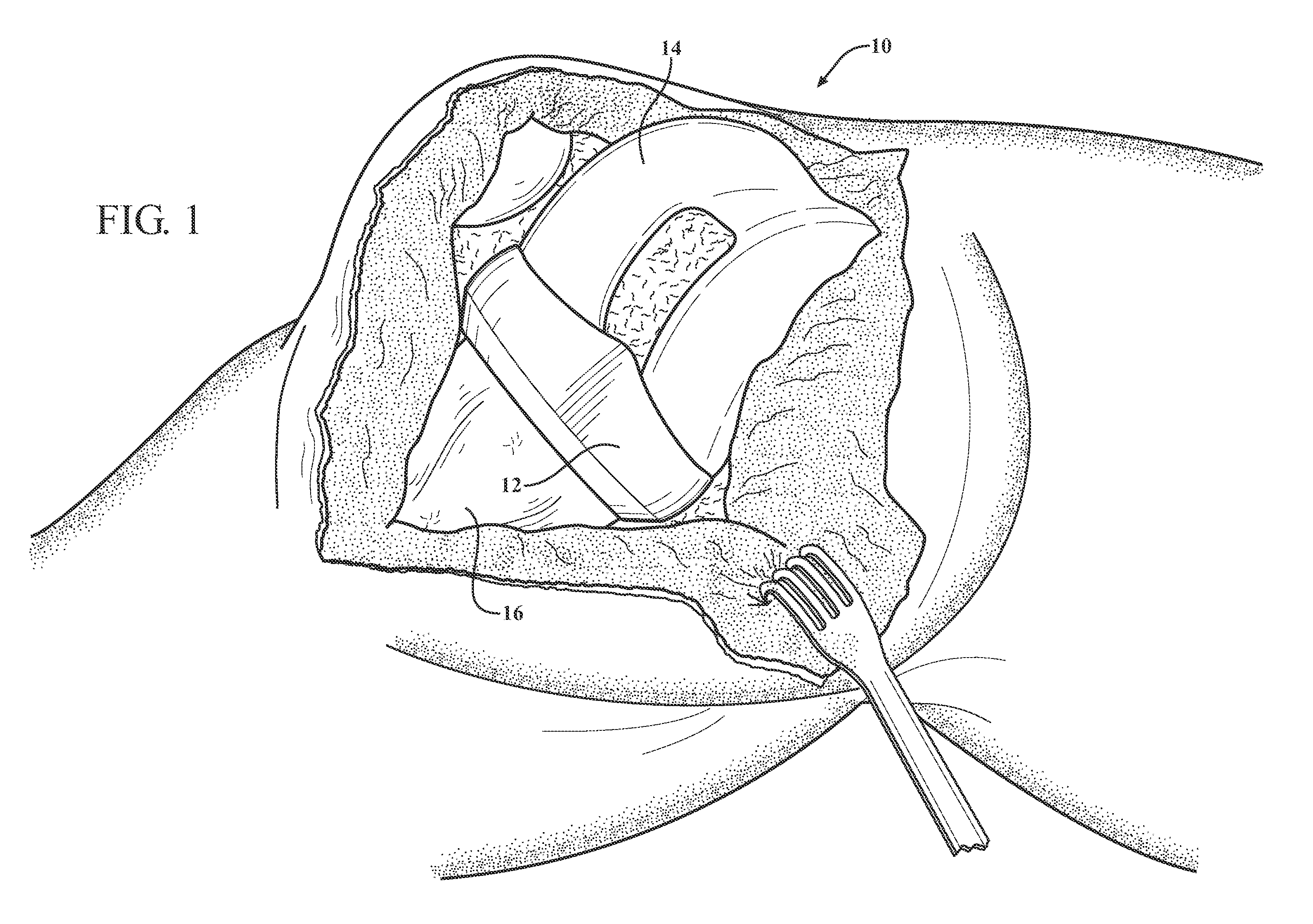 Antibiotic delivery system and method for treating an infected synovial joint during re-implantation of an orthopedic prosthesis