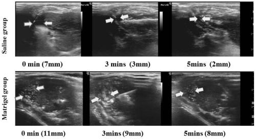 Application of heat-sensitive materials in the preparation of injections for protecting the surrounding structures of organs during thermal ablation