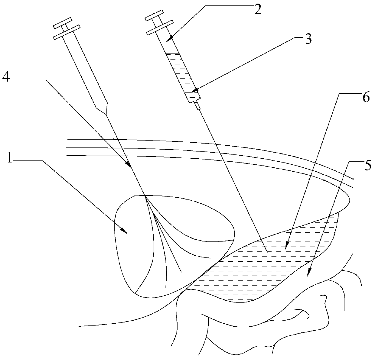 Application of heat-sensitive materials in the preparation of injections for protecting the surrounding structures of organs during thermal ablation