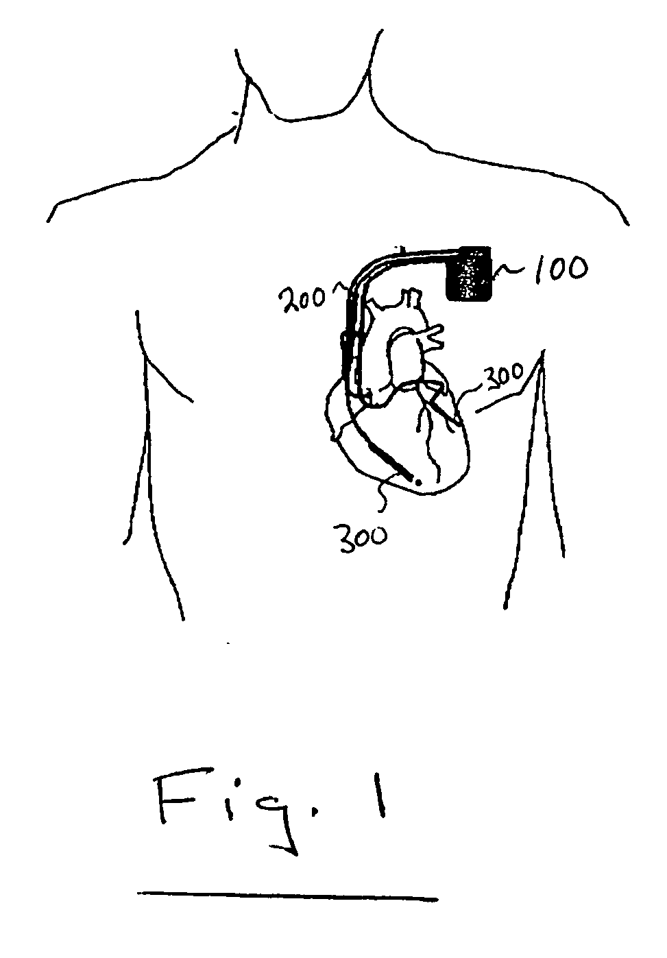 Pressure sensing for feedback control of post-MI remodeling control pacing