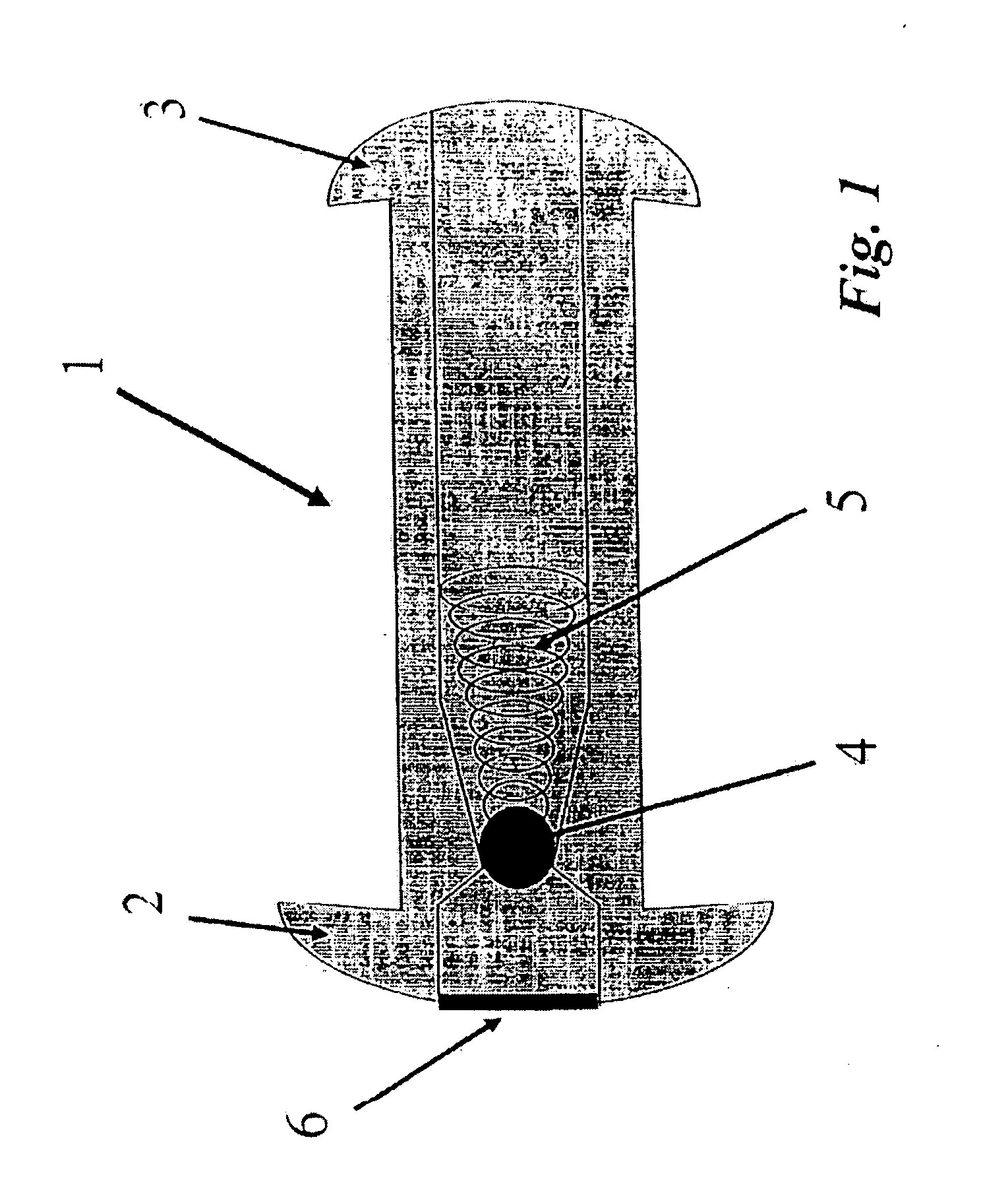 Implantable fluid management system for the removal of excess fluid