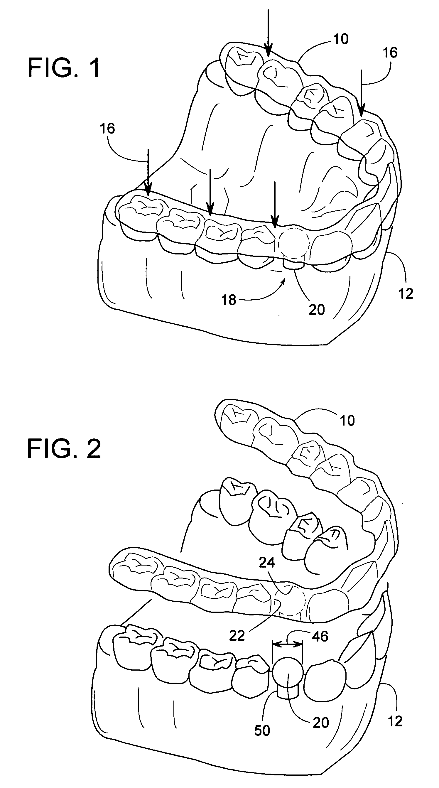 Spherical drill bushing for installing a dental implant