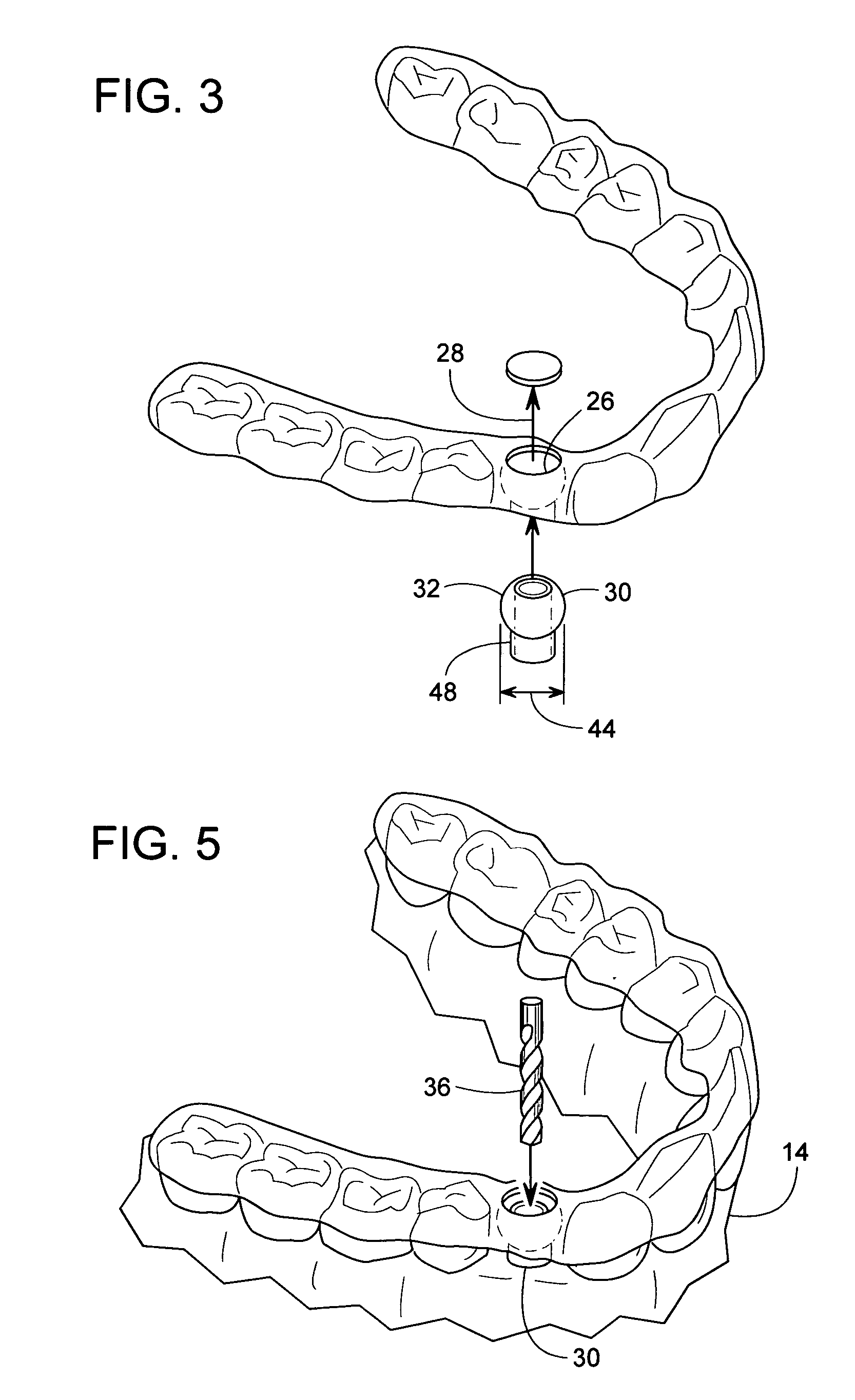 Spherical drill bushing for installing a dental implant