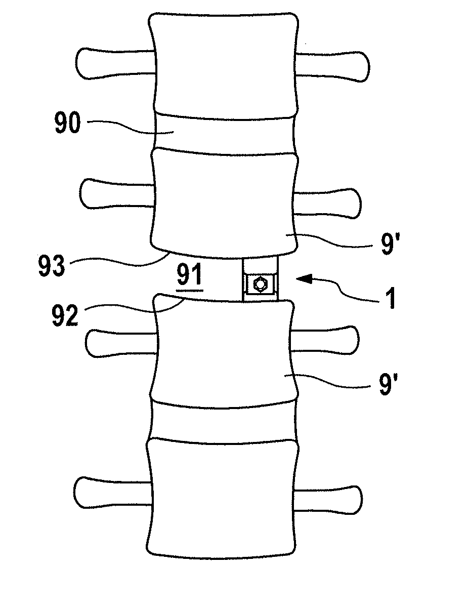 Continuously height-adjustable intervertebral fusion implant