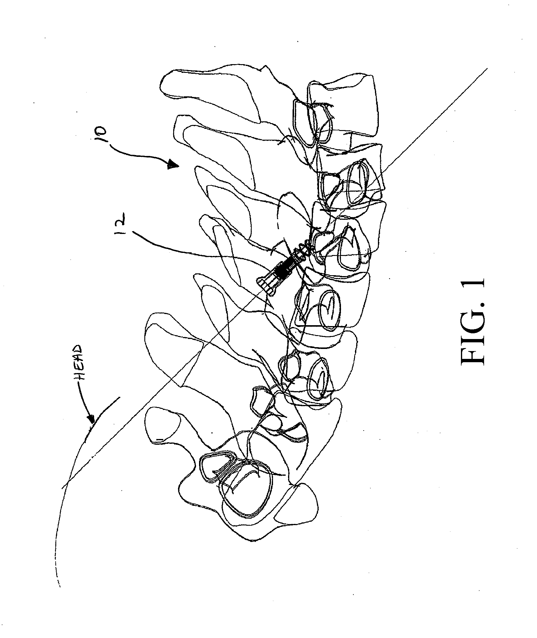 Method and apparatus for spinal fixation