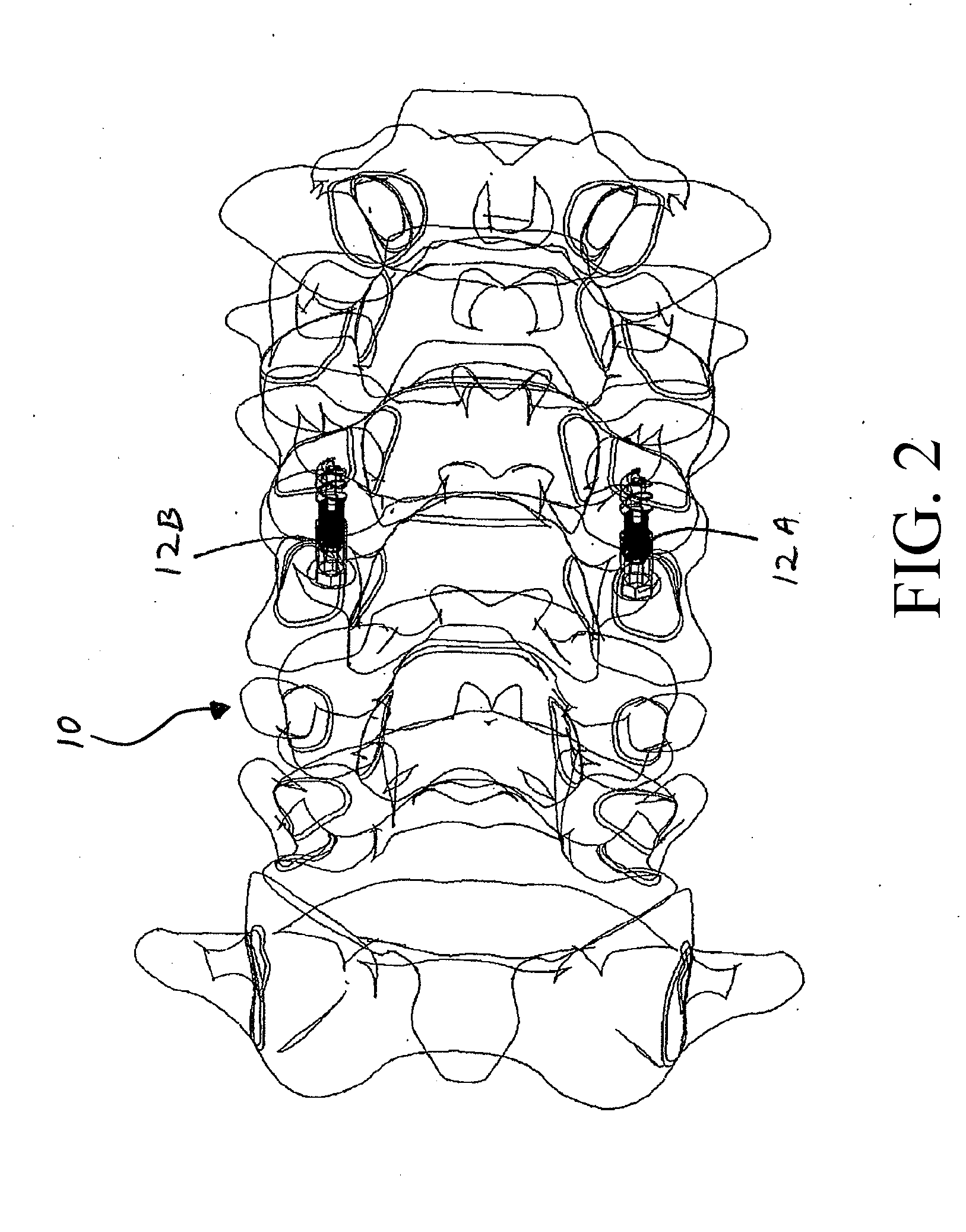 Method and apparatus for spinal fixation