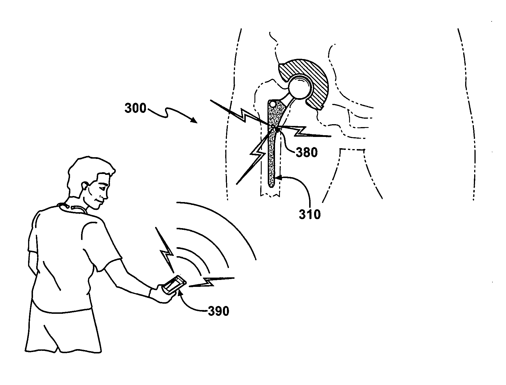 Prophylactic bactericidal implant