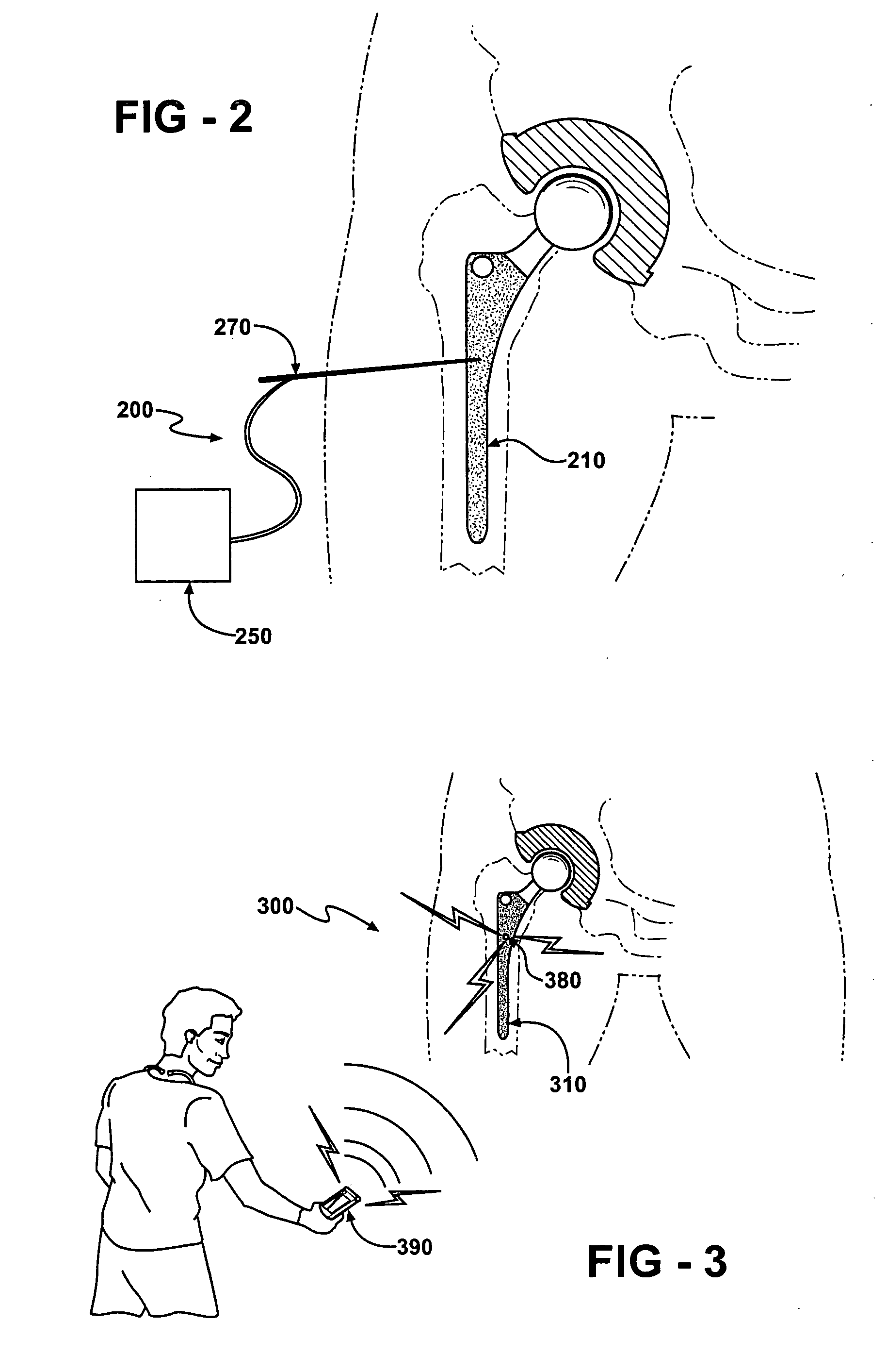 Prophylactic bactericidal implant