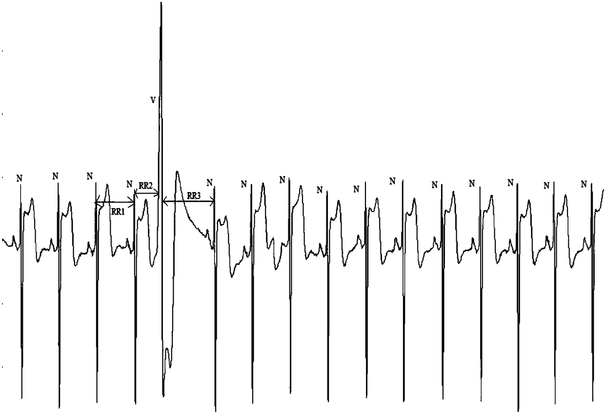 Classifier fusion and diagnosis rule based premature ventricular contraction (PVC) identification system and method