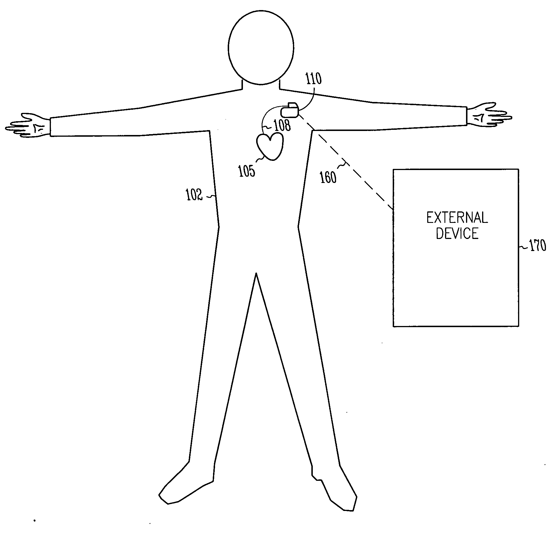 Dual sensing for brady-tachy pacemaker/ICD