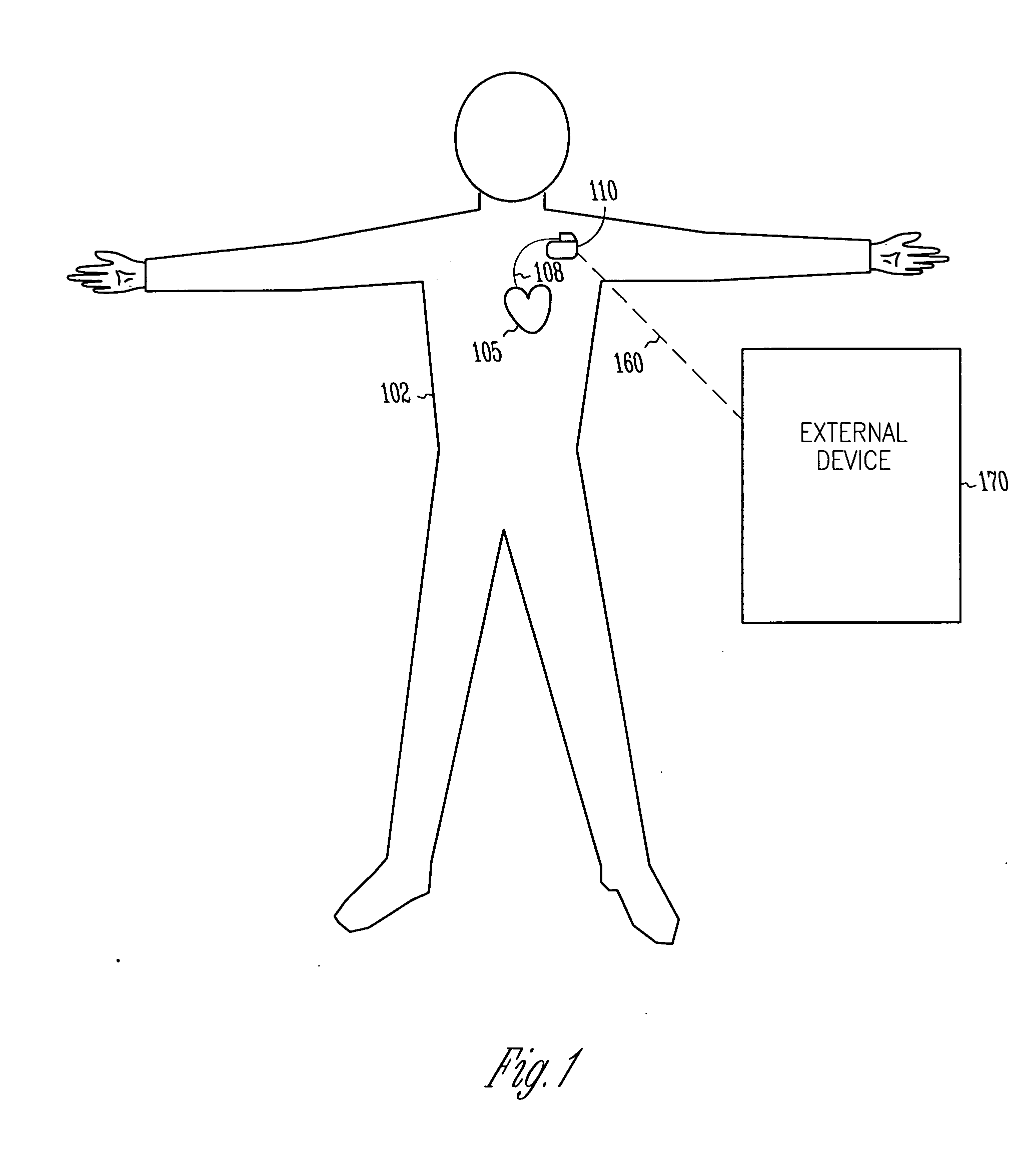 Dual sensing for brady-tachy pacemaker/ICD