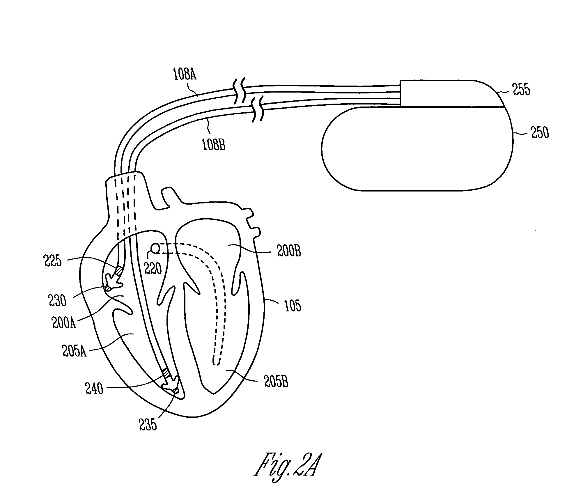 Dual sensing for brady-tachy pacemaker/ICD