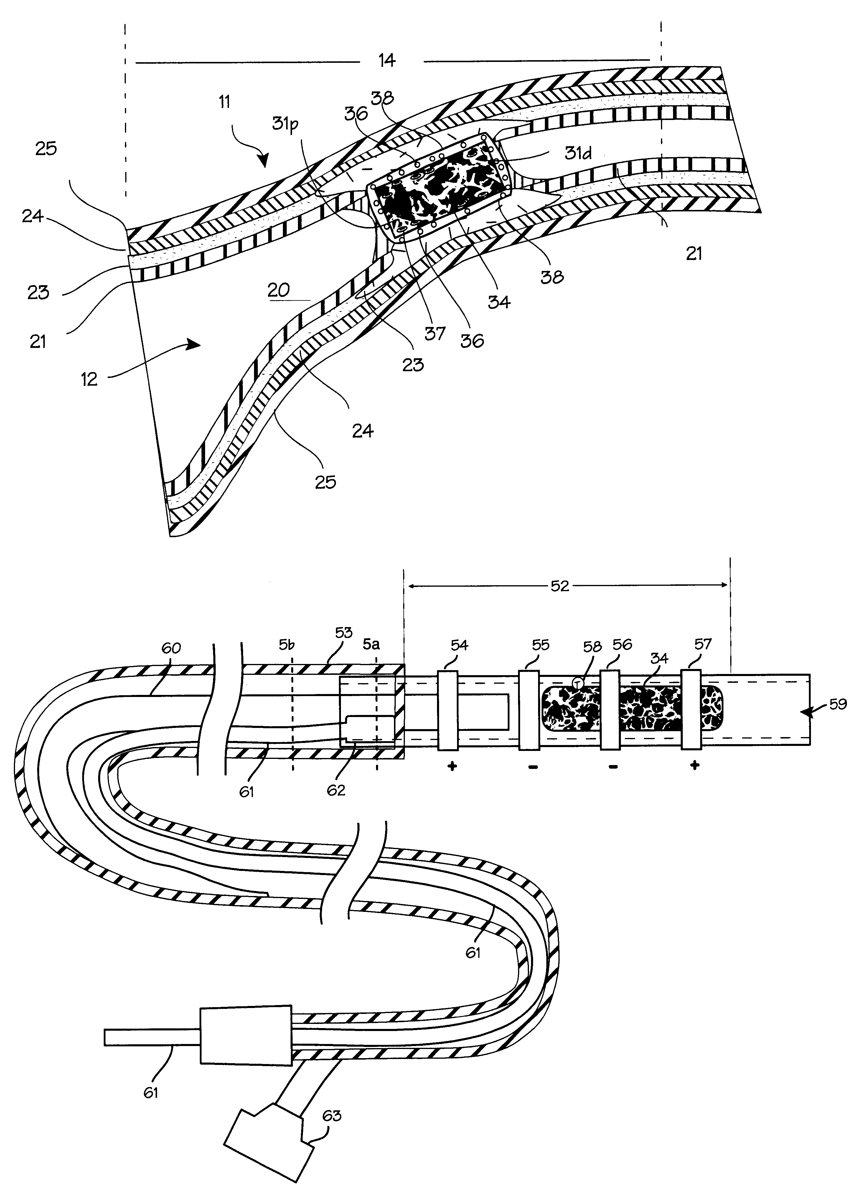 Method and apparatus for tubal occlusion