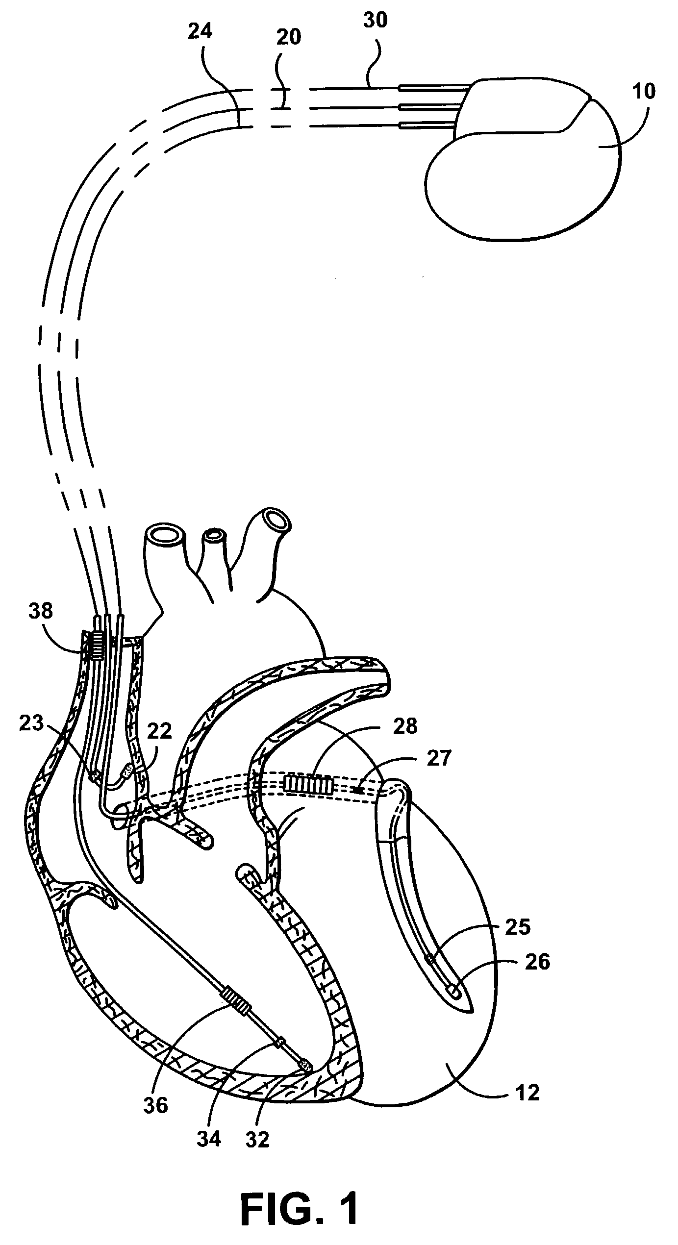 Implantable stimulation device with isolating system for minimizing magnetic induction