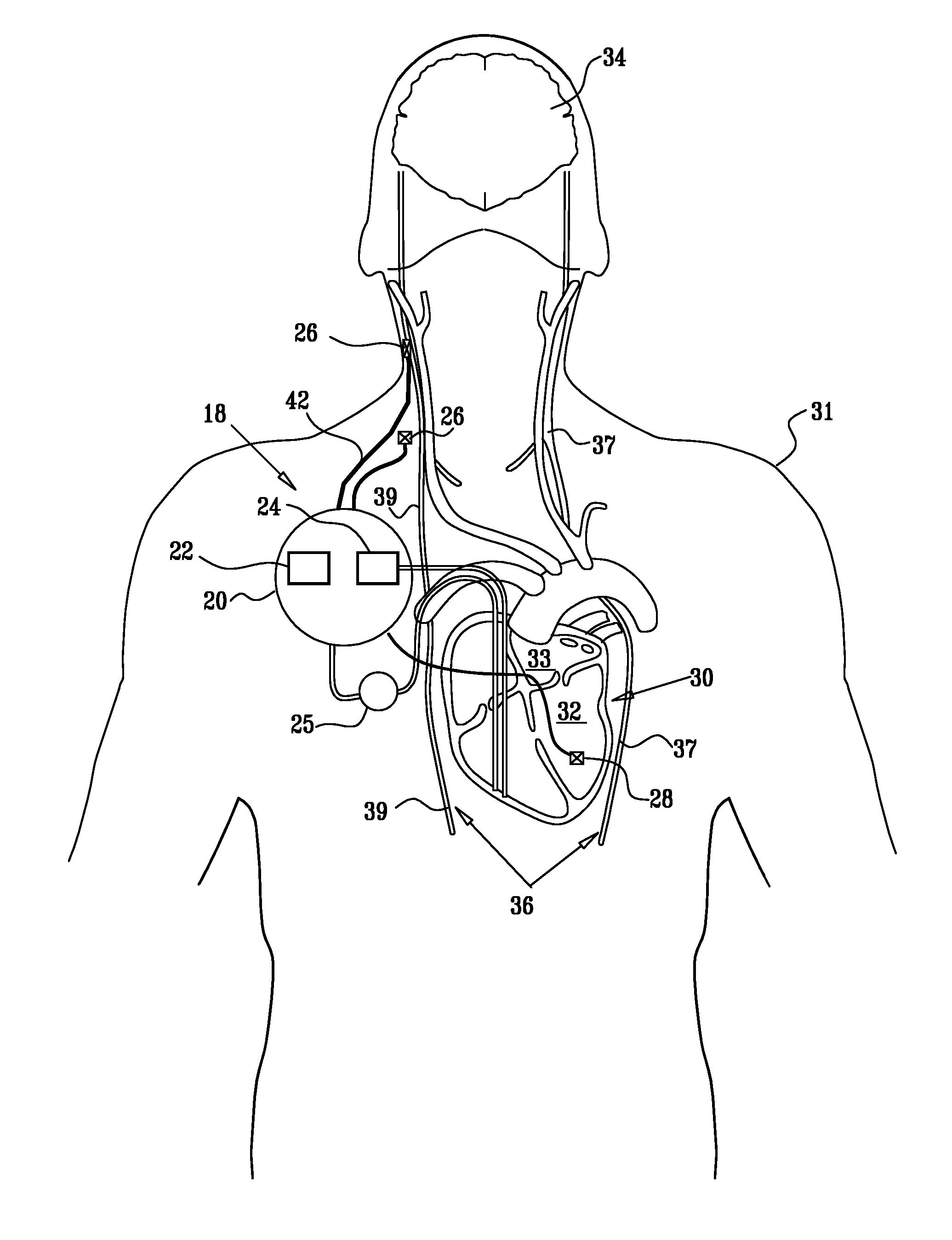 Techniques for reducing pain associated with nerve stimulation