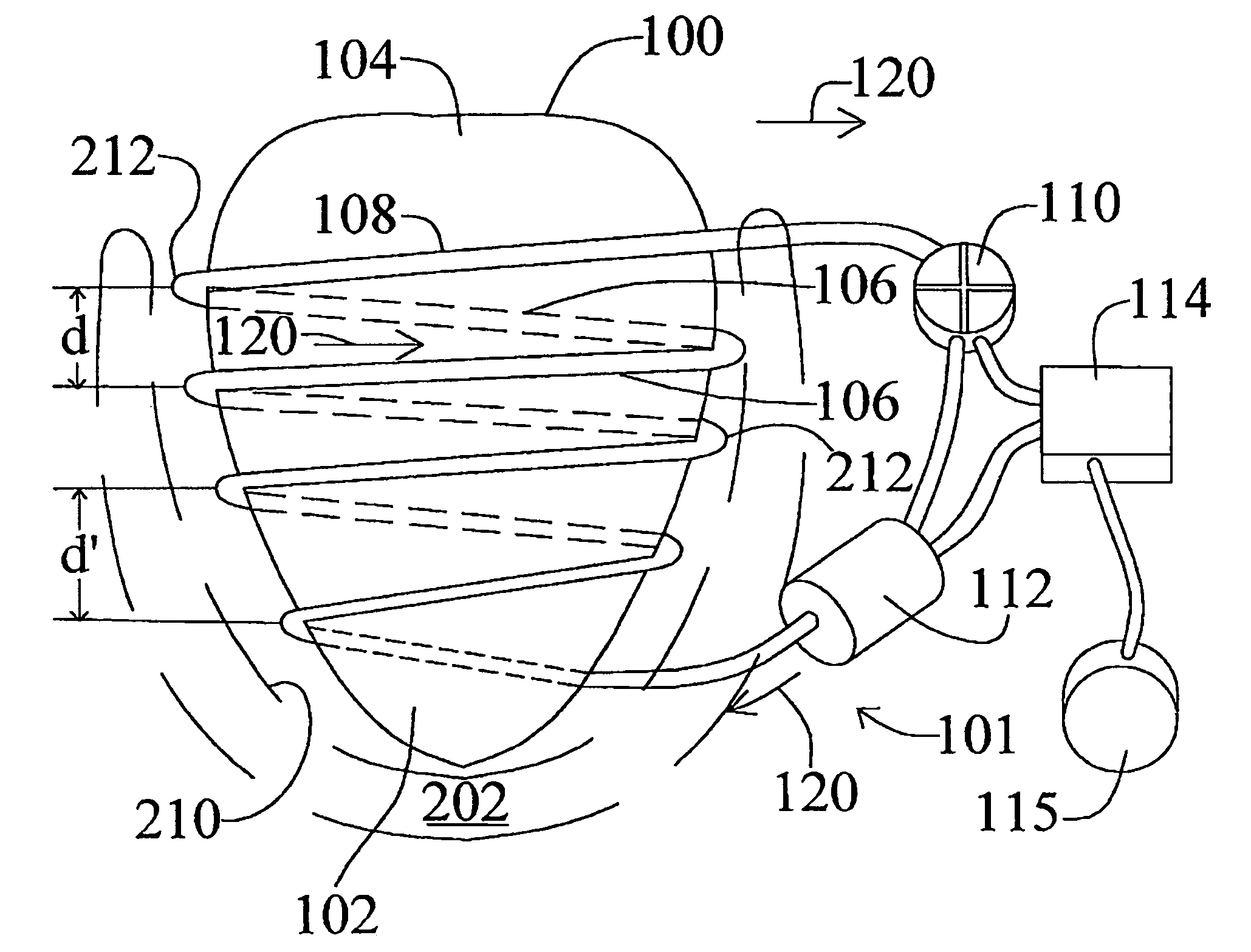 Implantable cardiac assist device