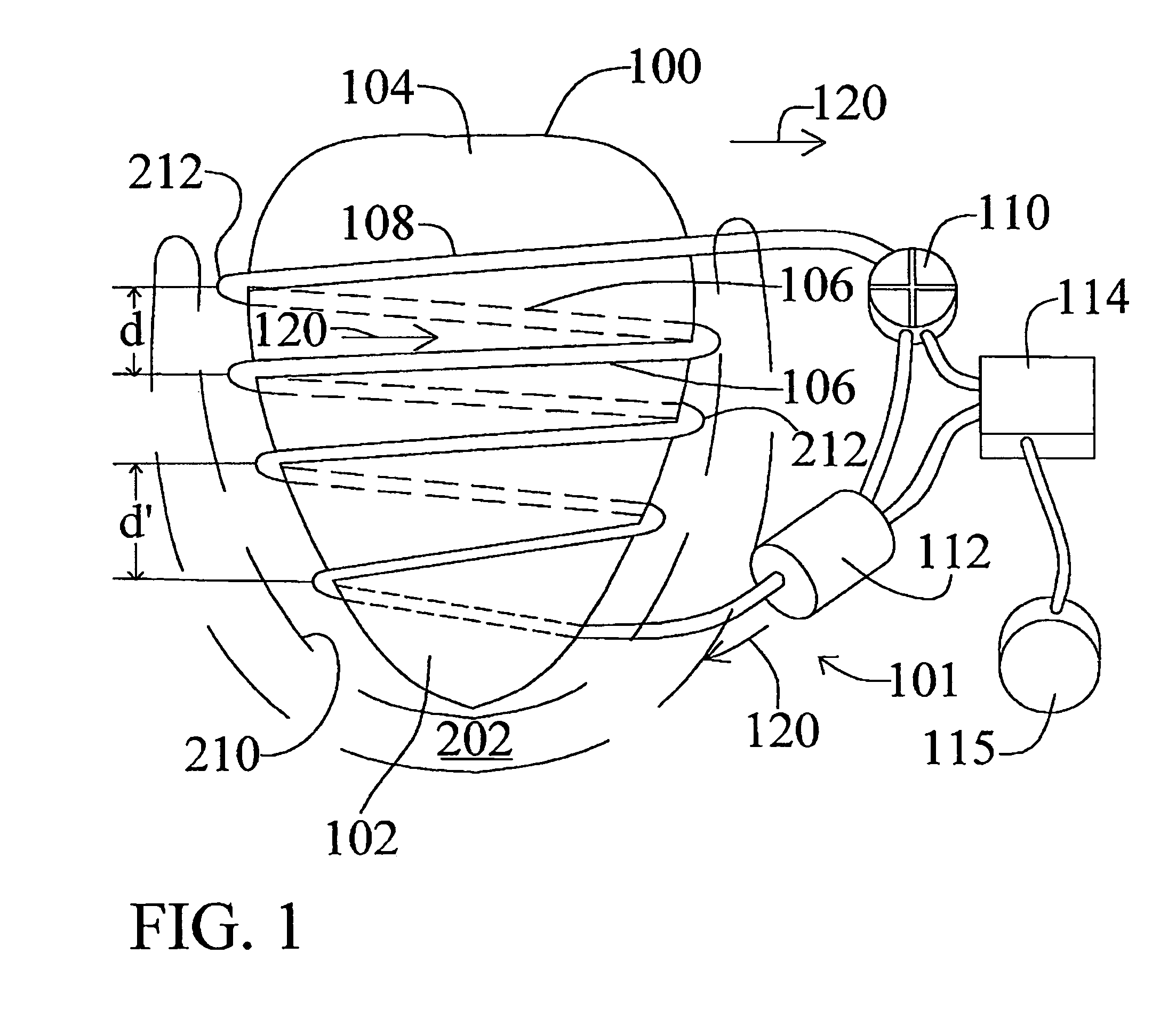 Implantable cardiac assist device