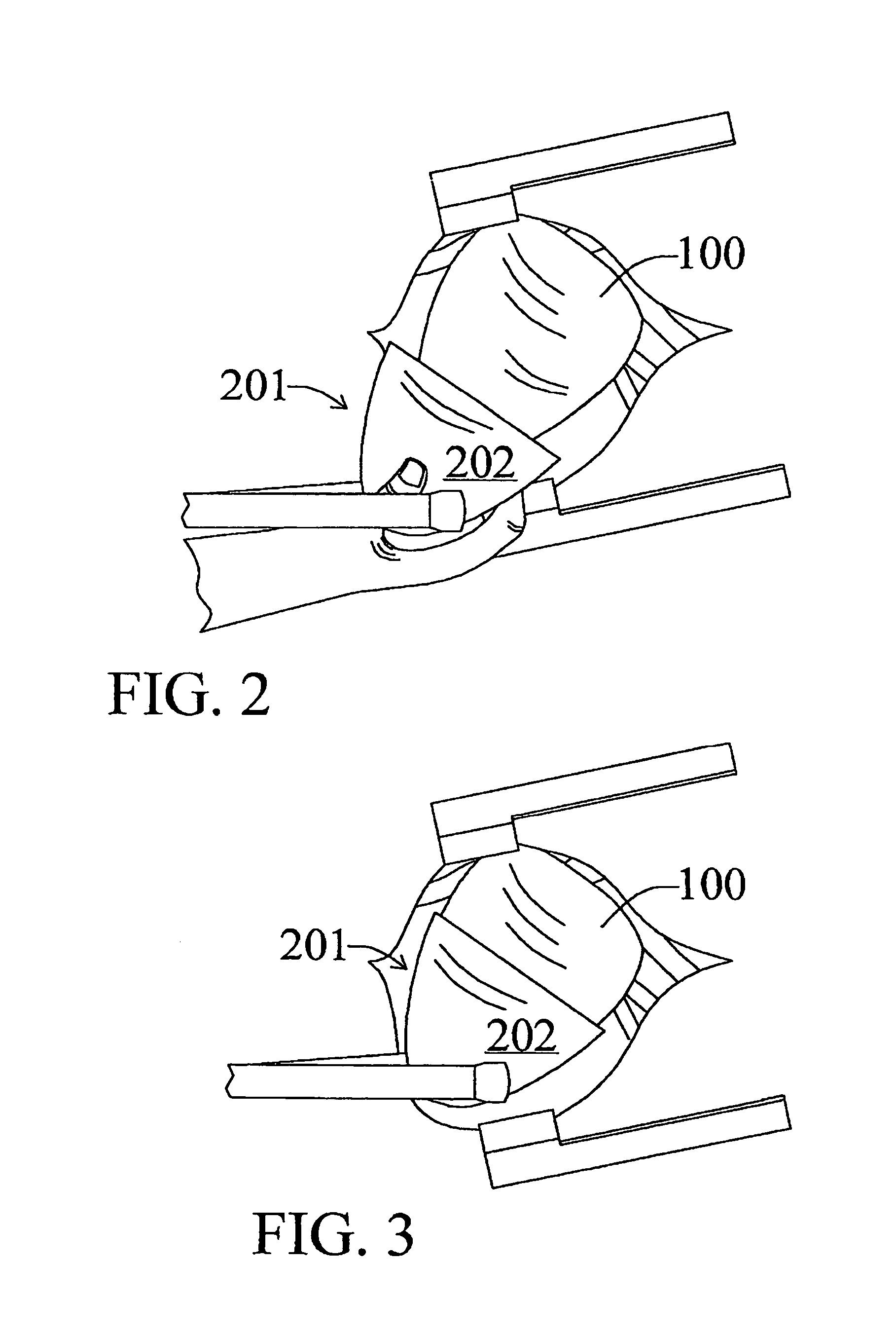 Implantable cardiac assist device