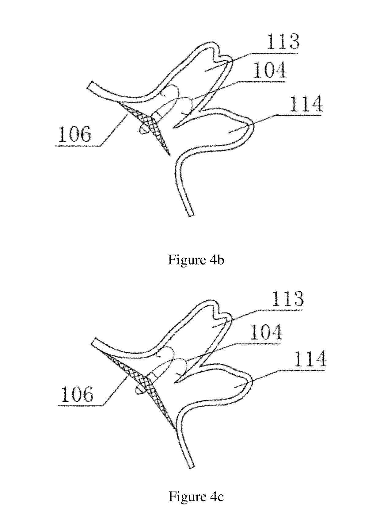 Left atrial appendage closure apparatus