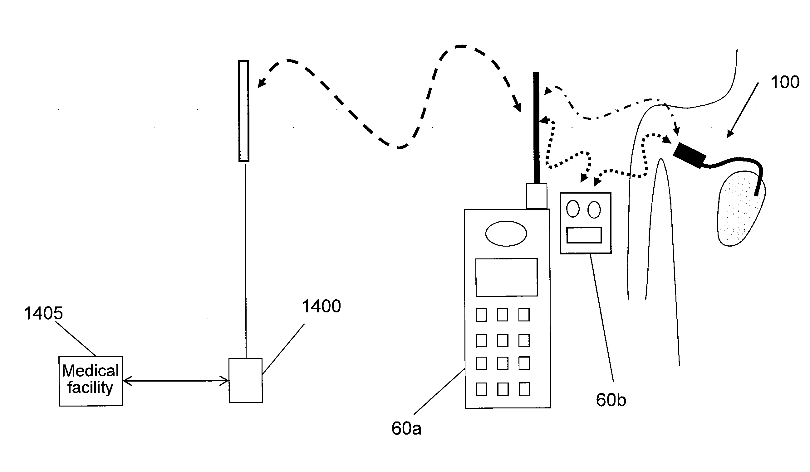 Atrial defibrillation using an implantable defibrillation system