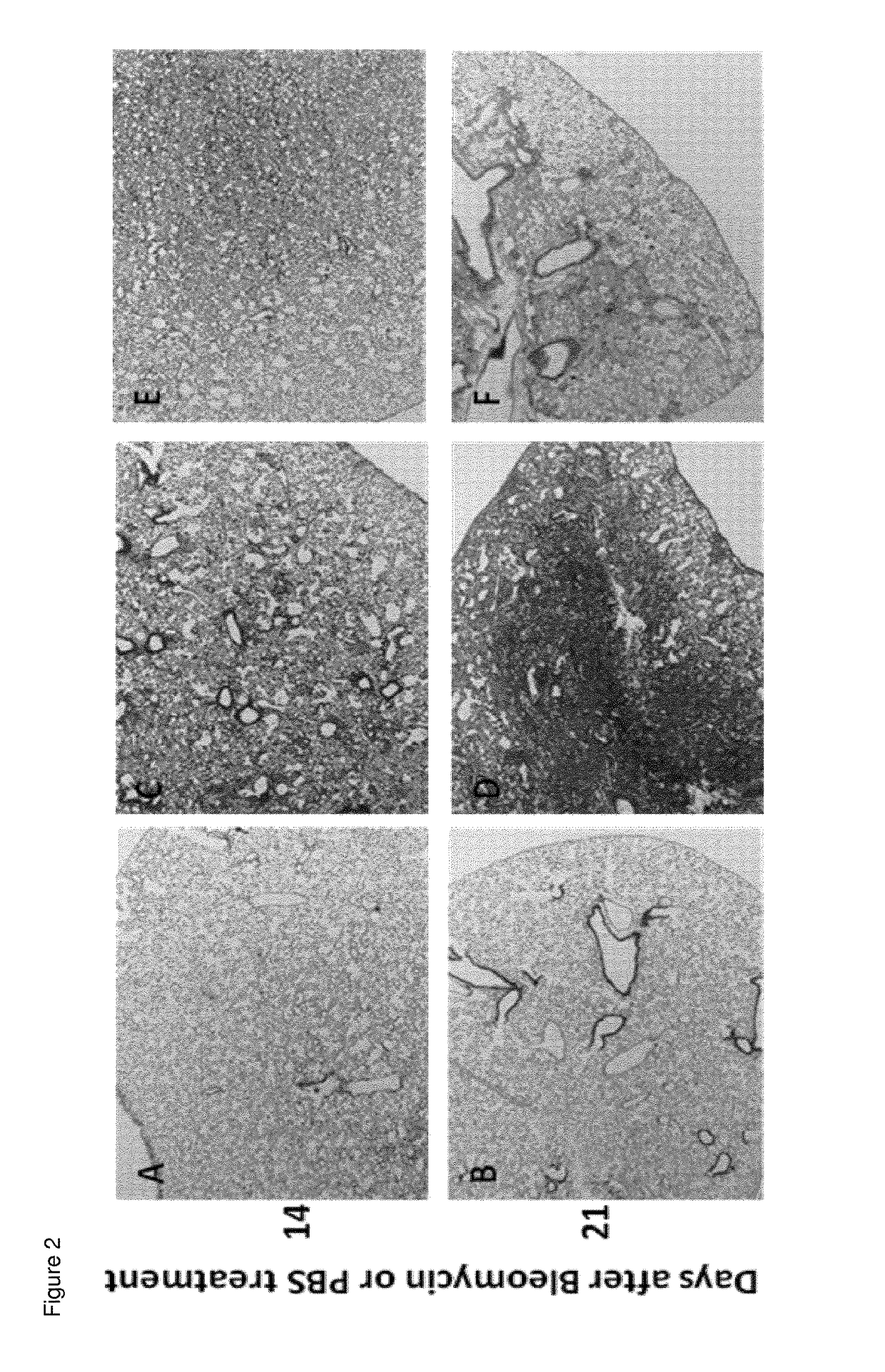 Method for the treatment of idiopathic pulmonary fibrosis