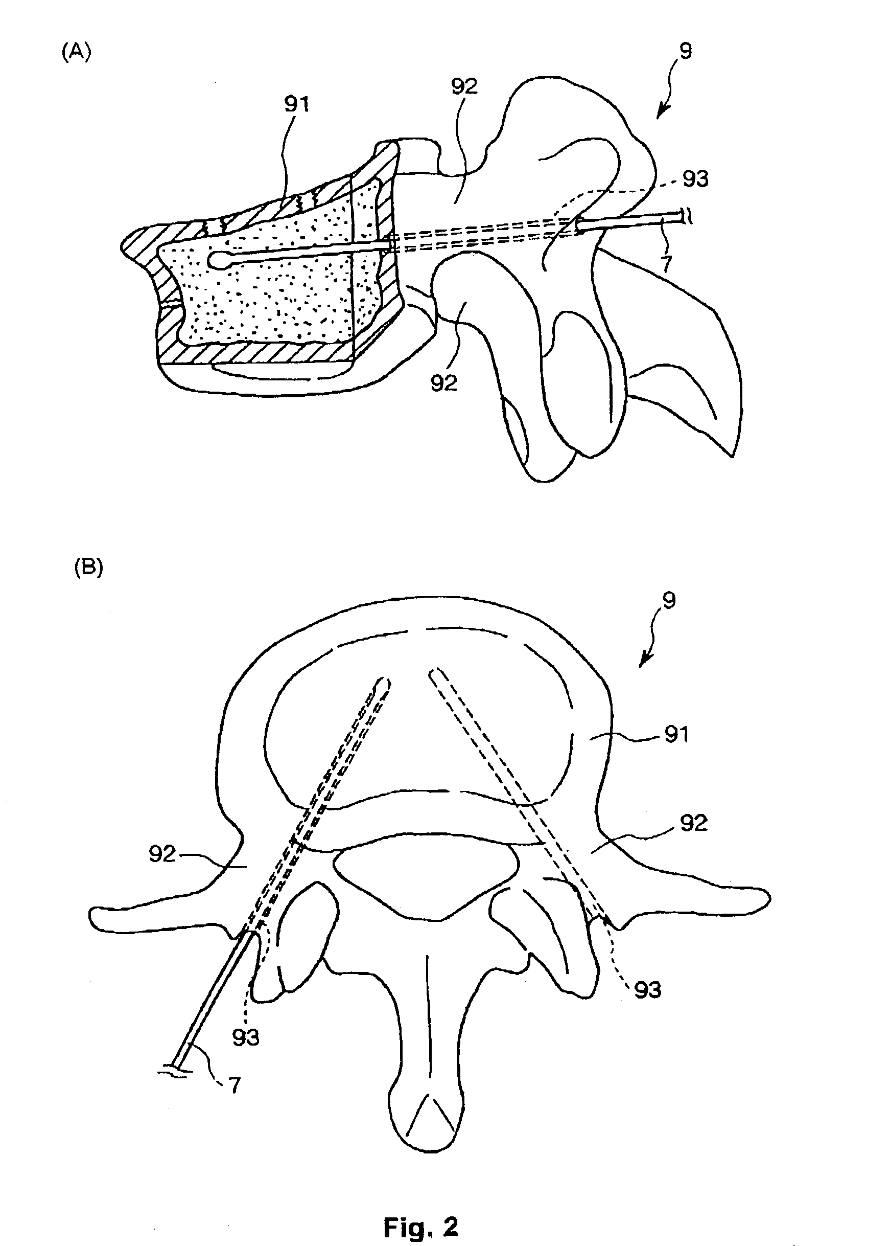 Bone replacement material