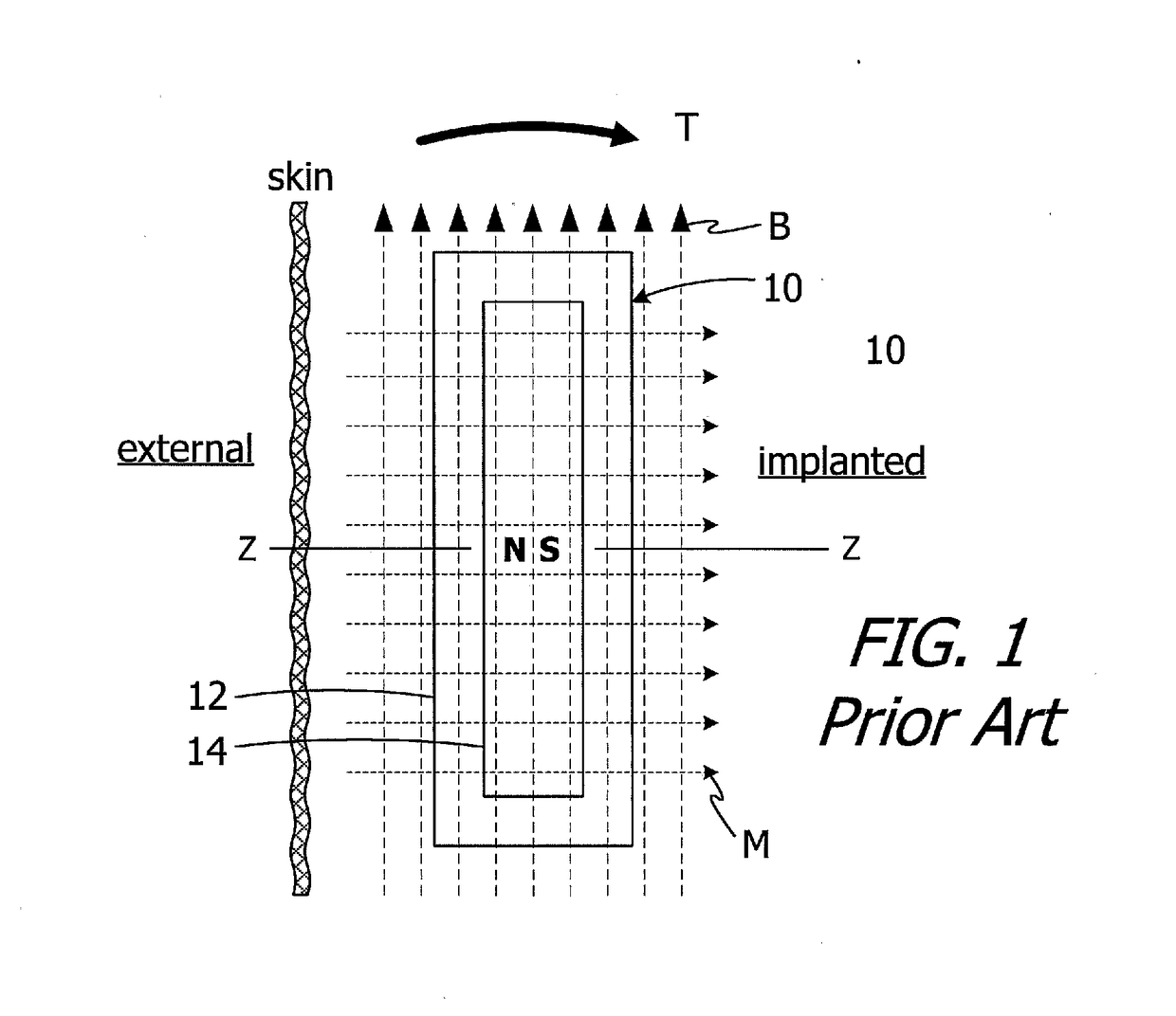 Cochlear implants having mri-compatible magnet apparatus and associated methods