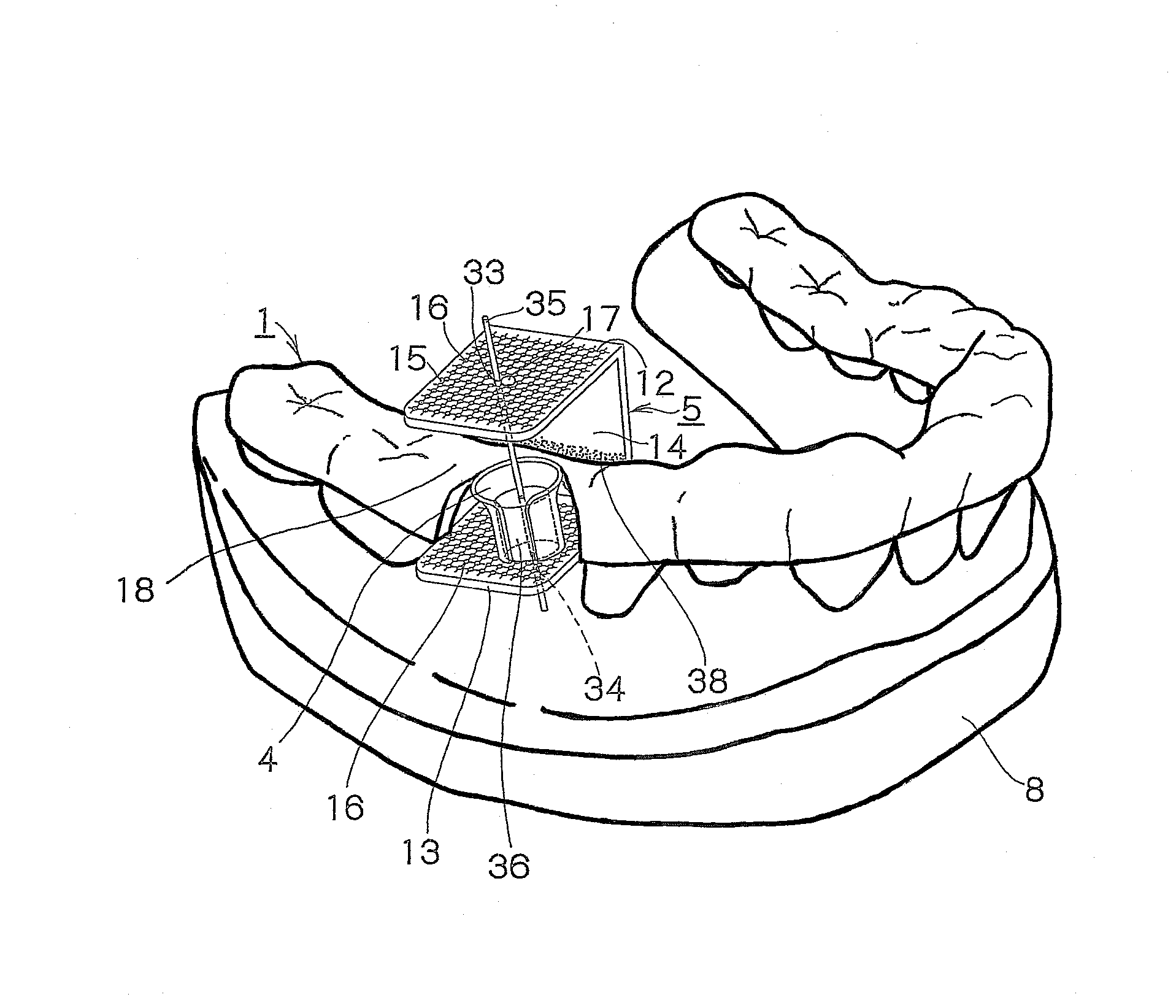 Surgical guide preparation tool and method for preparing surgical guide