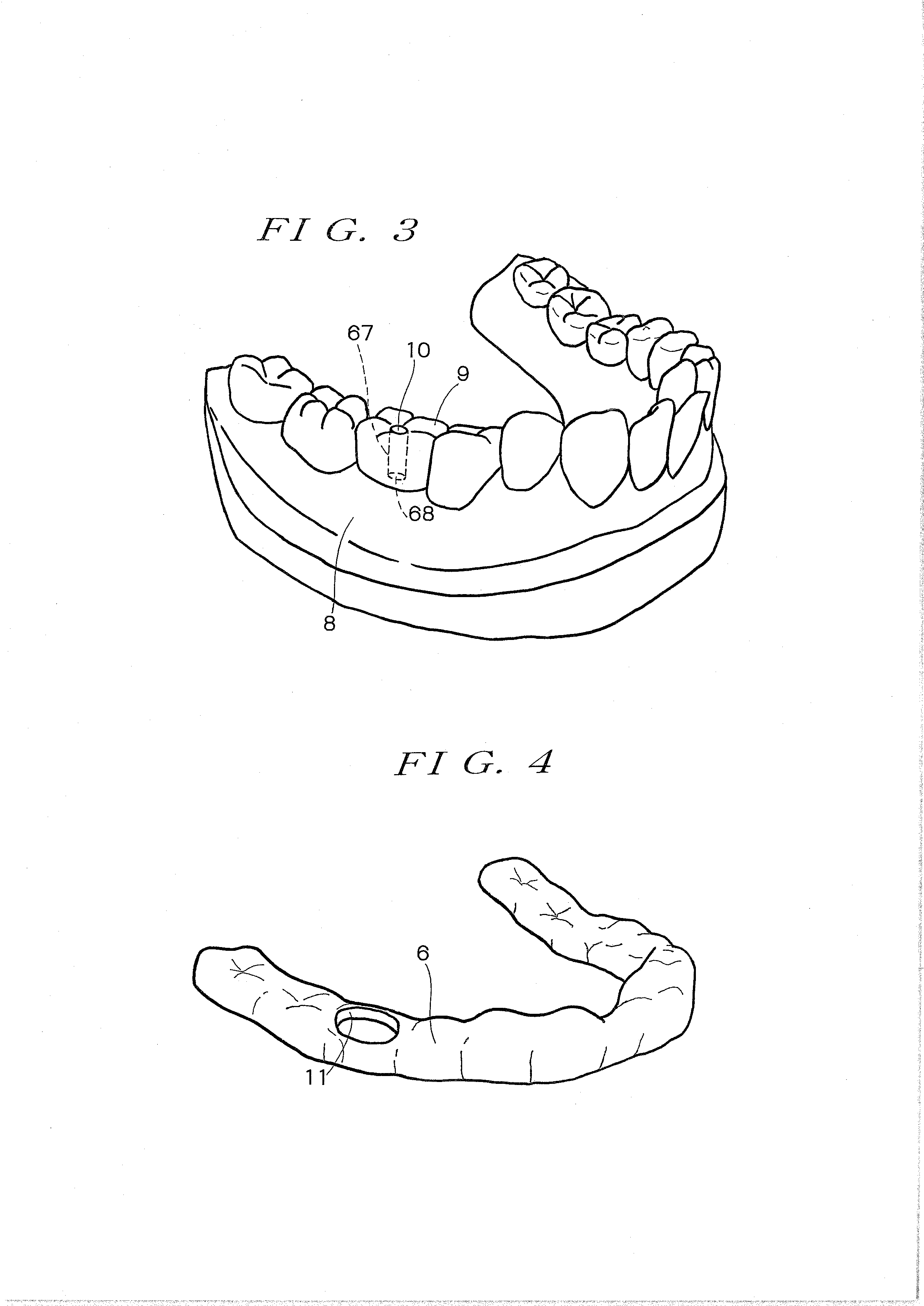 Surgical guide preparation tool and method for preparing surgical guide