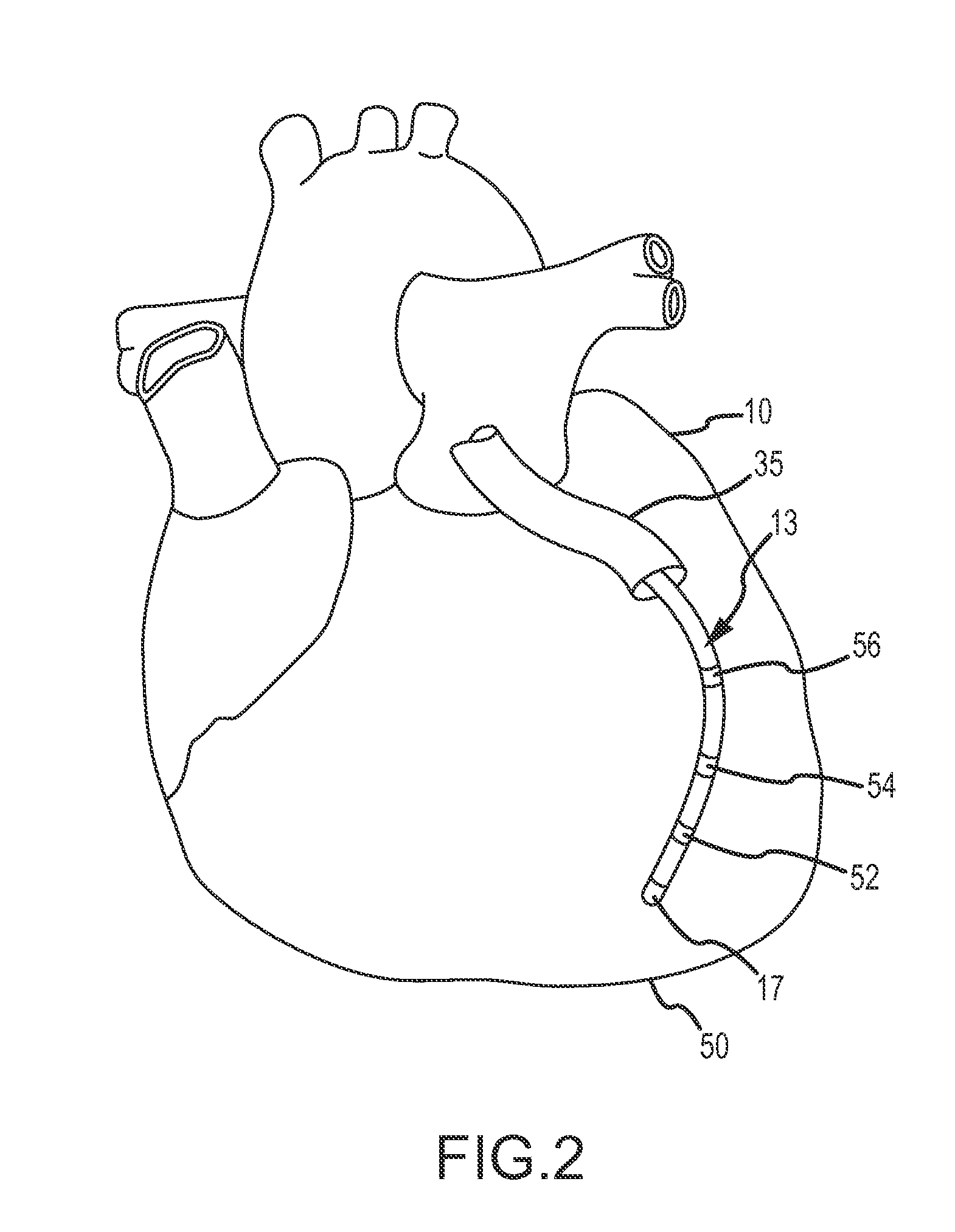 System and Method for Generating Electrophysiology Maps