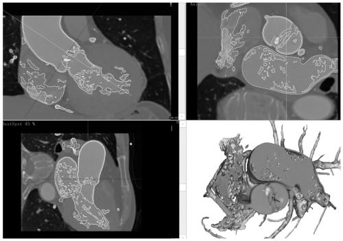 3D model construction method and preparation method for aortic valve disease