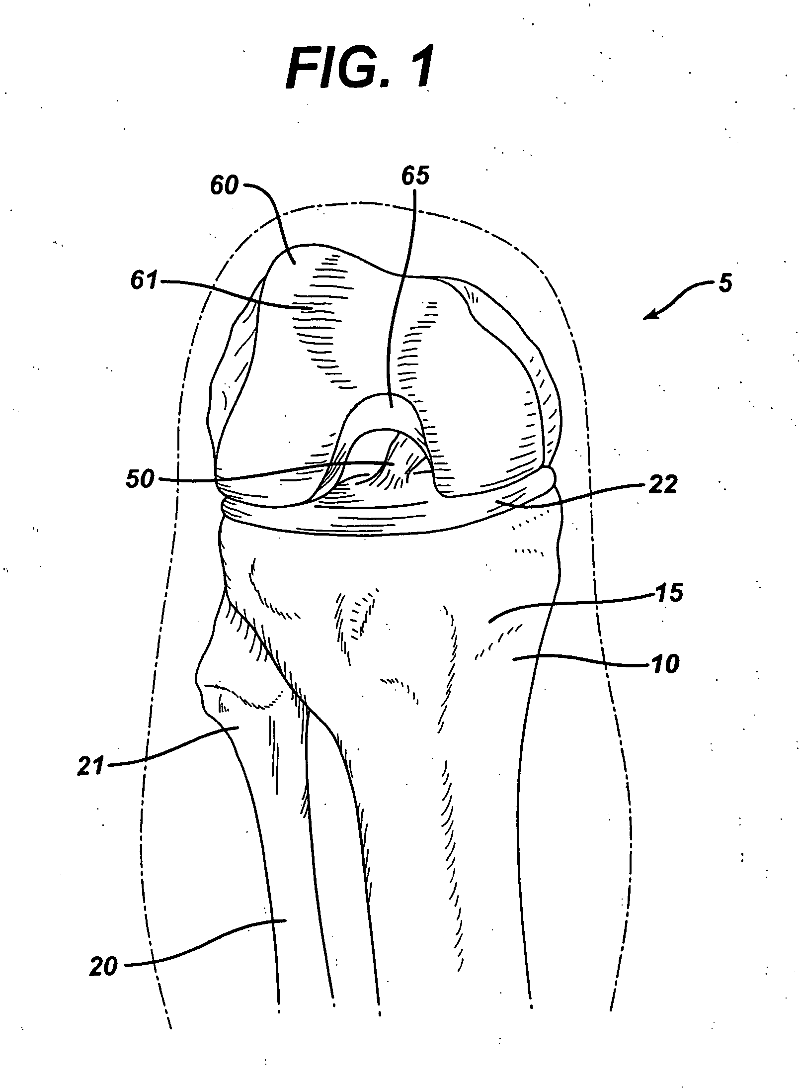 Method of replacing an anterior cruciate ligament in the knee