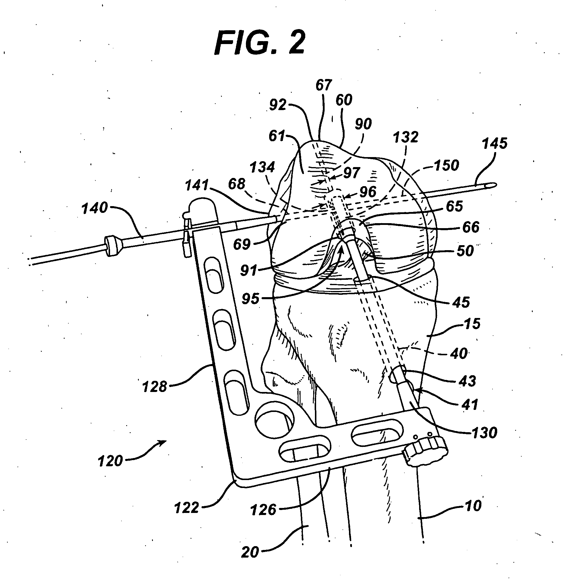 Method of replacing an anterior cruciate ligament in the knee