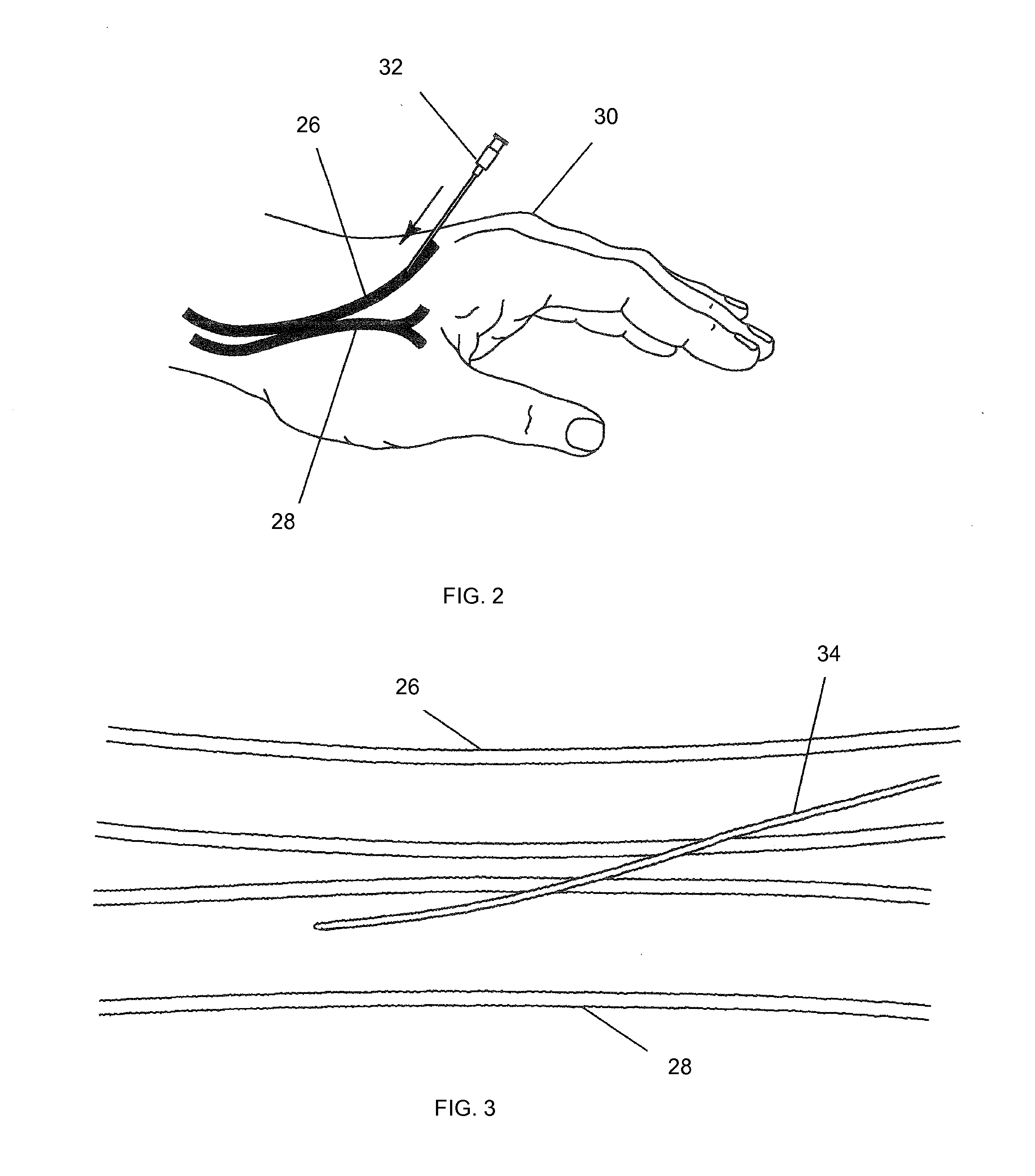 Intravascular arterial to venous anastomosis and tissue welding catheter