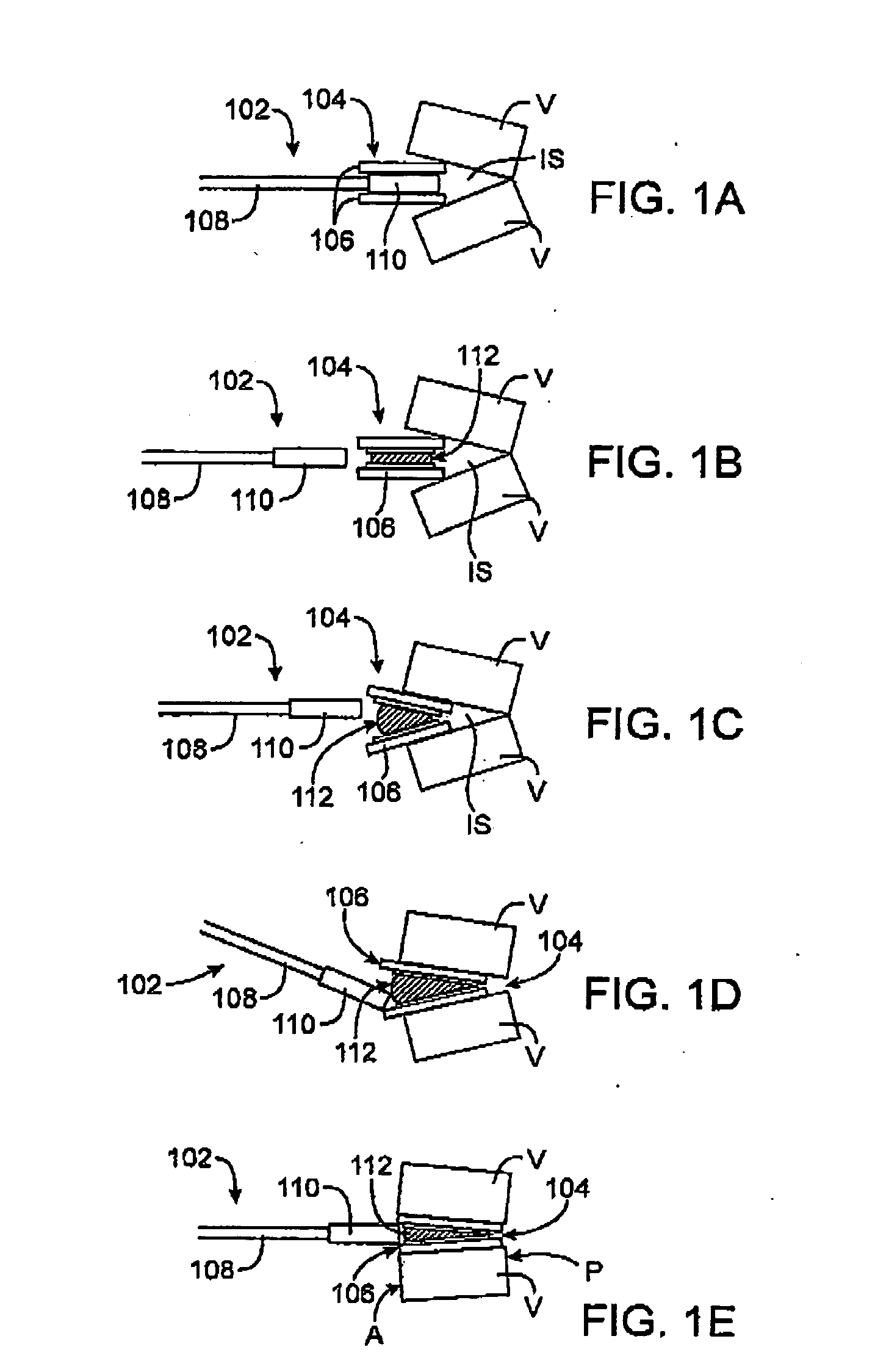 Methods and apparatus for intervertebral disc prosthesis insertion