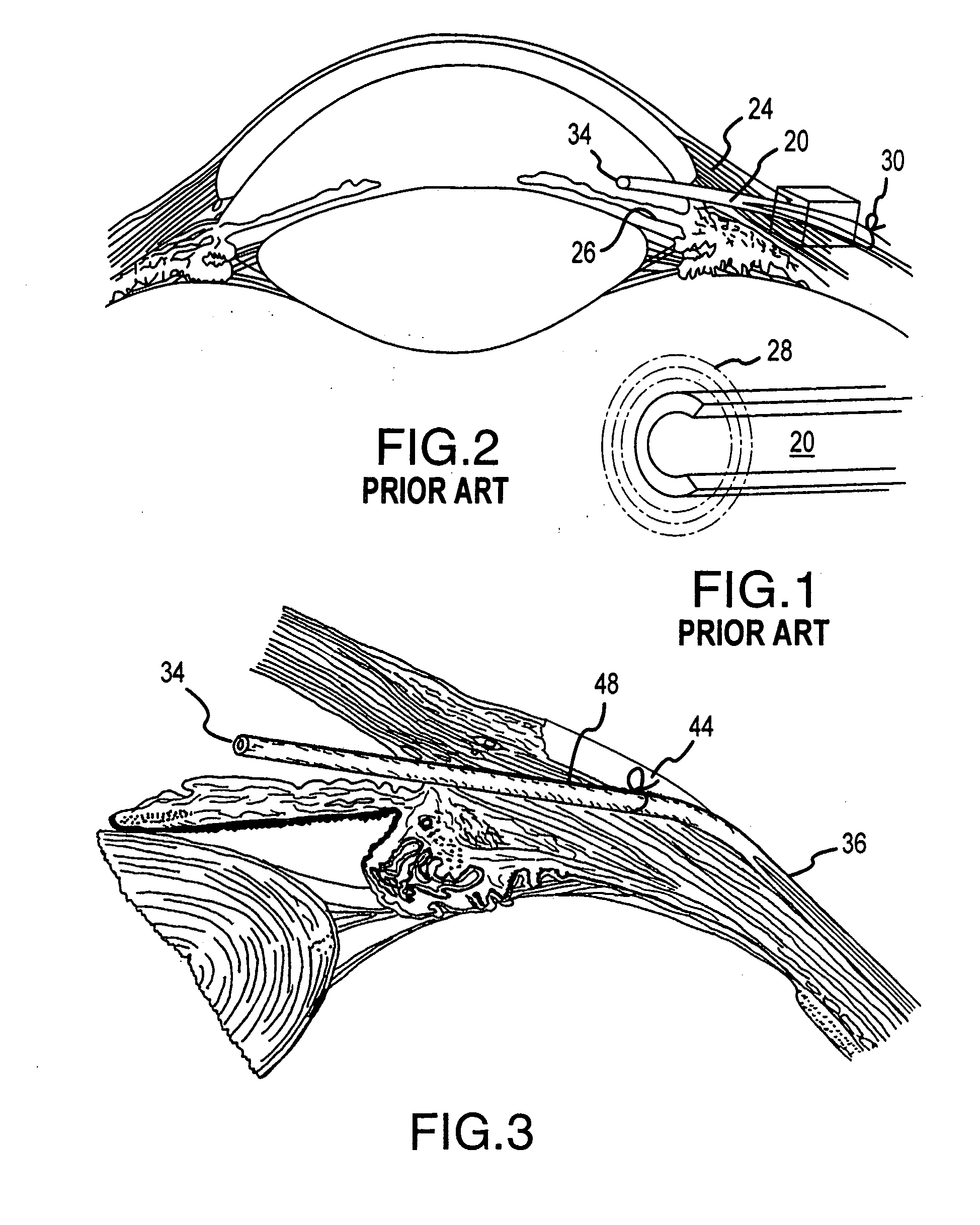 C-shaped cross section tubular ophthalmic implant for reduction of intraocular pressure in glaucomatous eyes and method of use