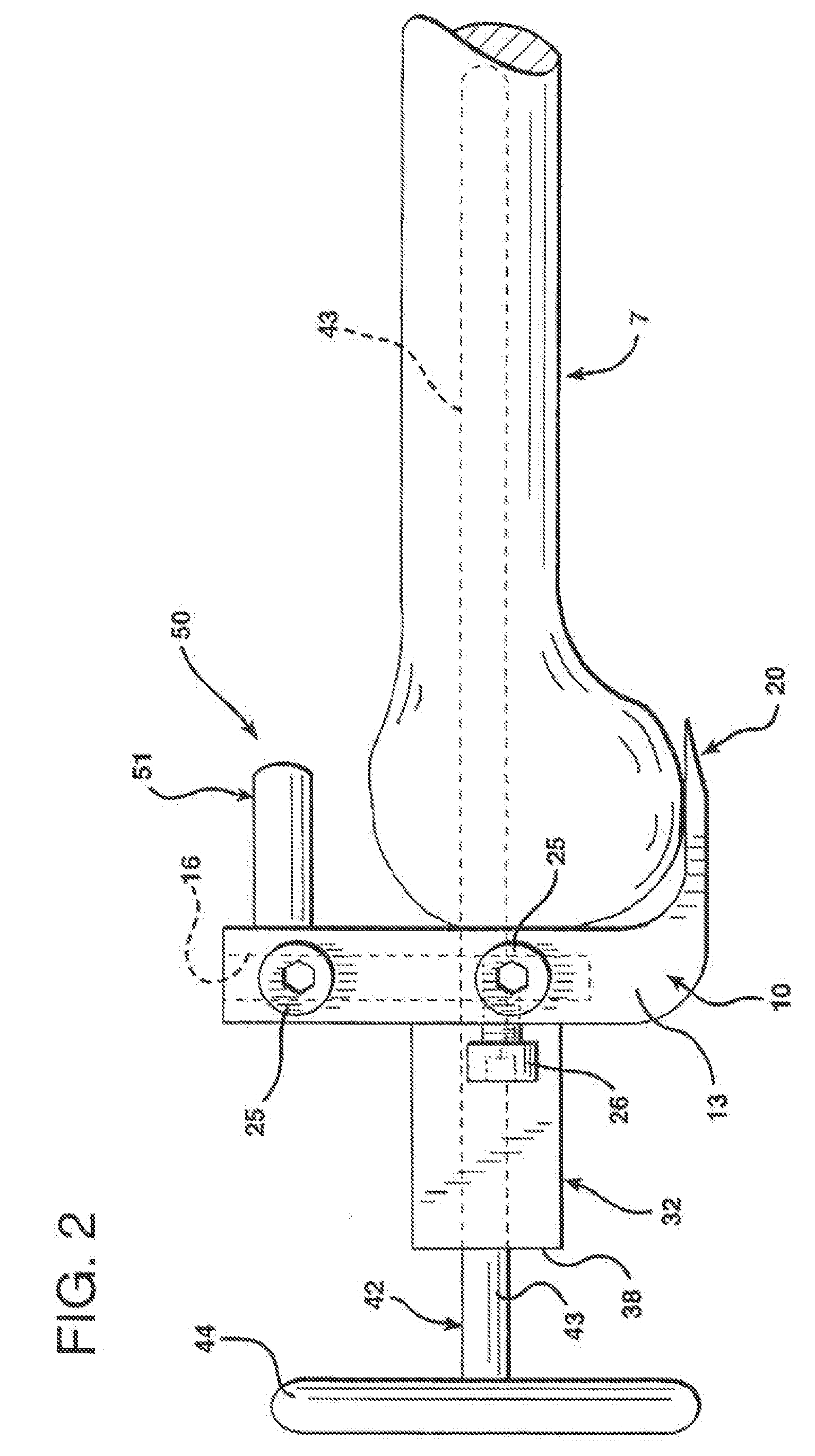 Methods and apparatus for knee arthroplasty