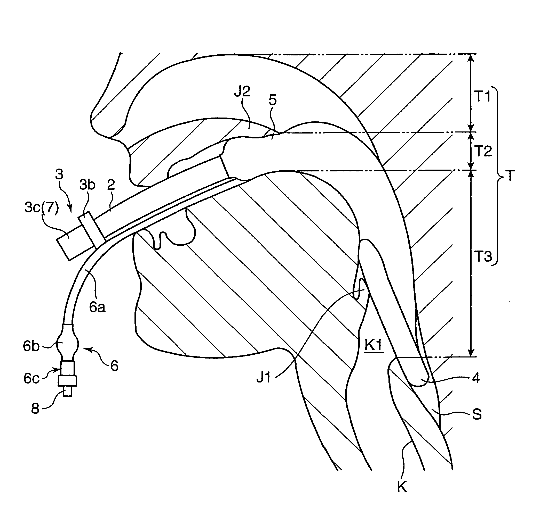 Brain cooling apparatus and fluid injection apparatus used therefor